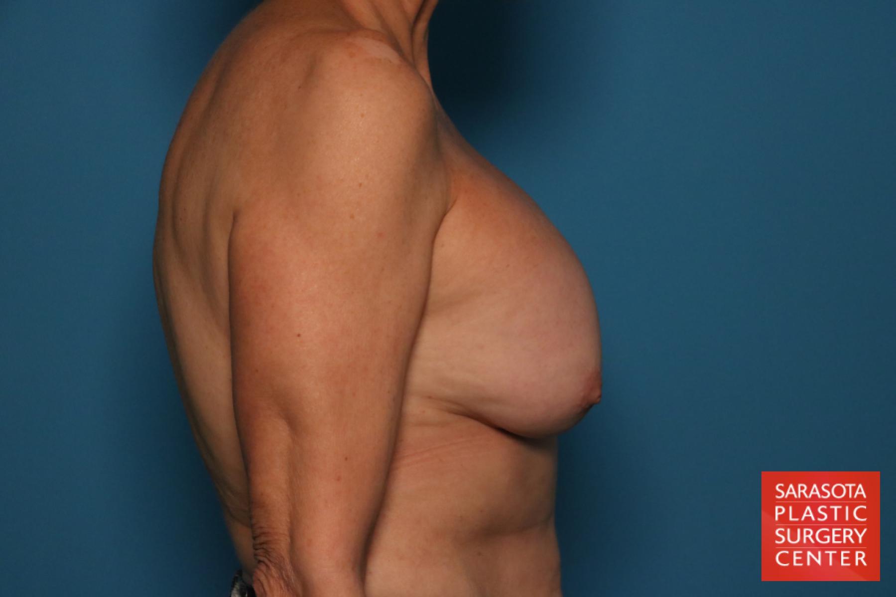 Breast Revision: Patient 15 - Before and After 3