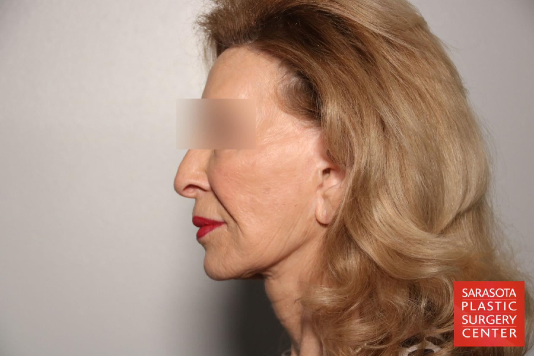 Cheek Lift: Patient 11 - Before and After 3