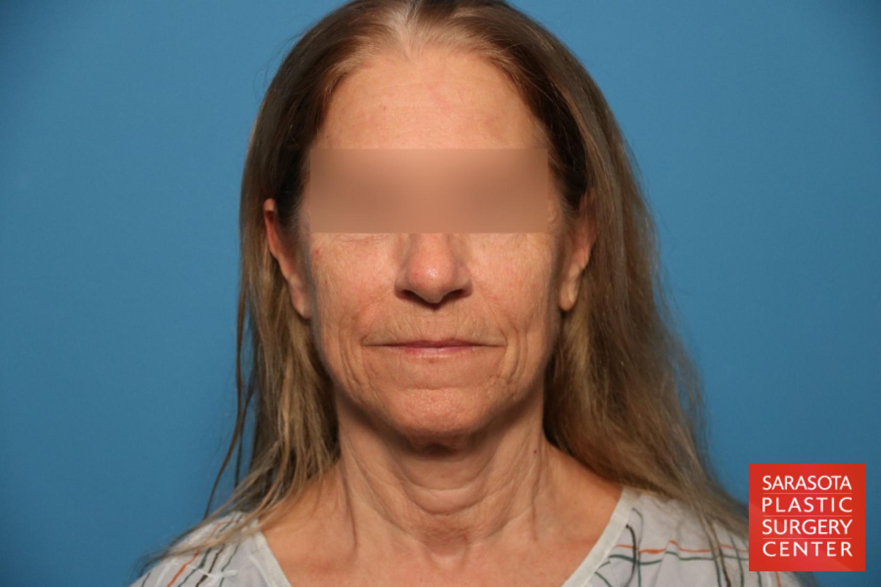Laser Skin Resurfacing - Face: Patient 13 - Before 1
