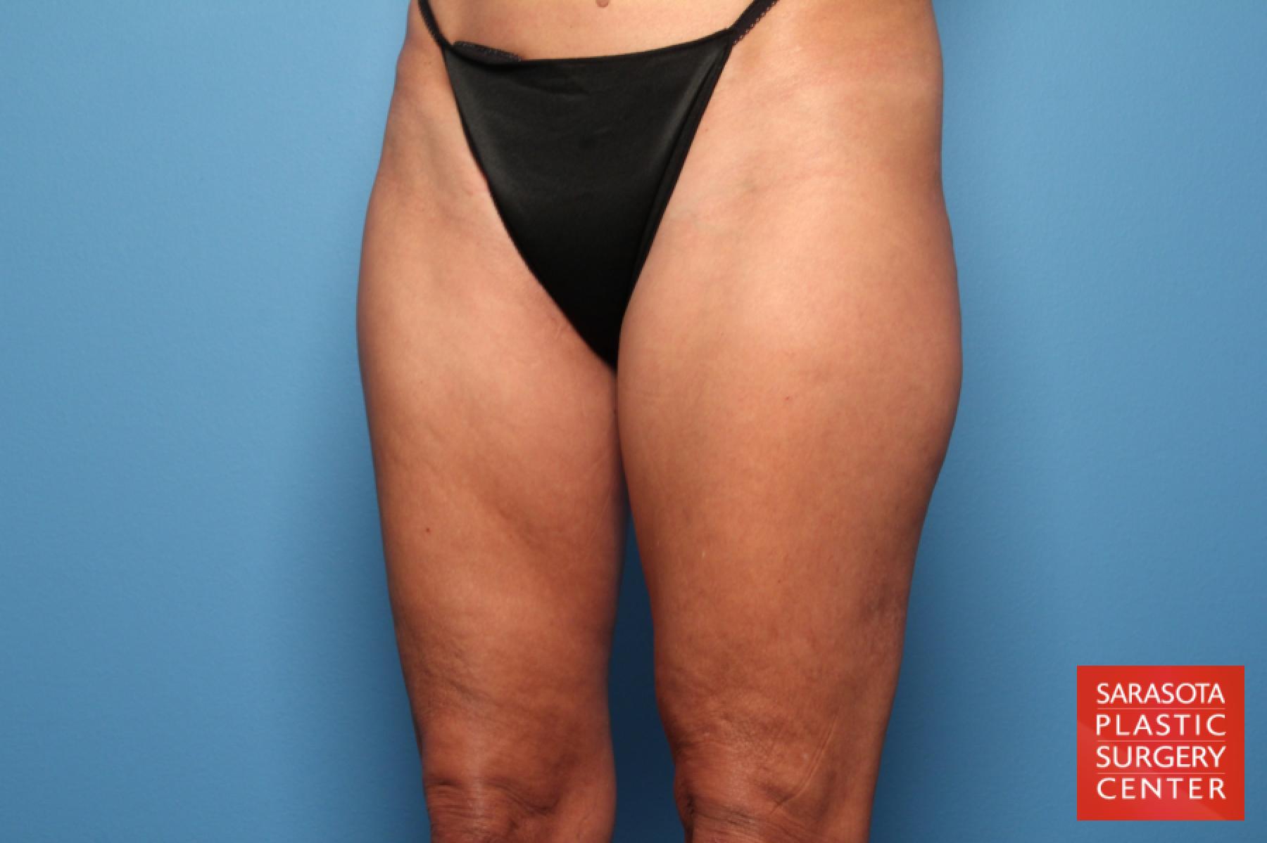 Liposuction: Patient 3 - Before 2