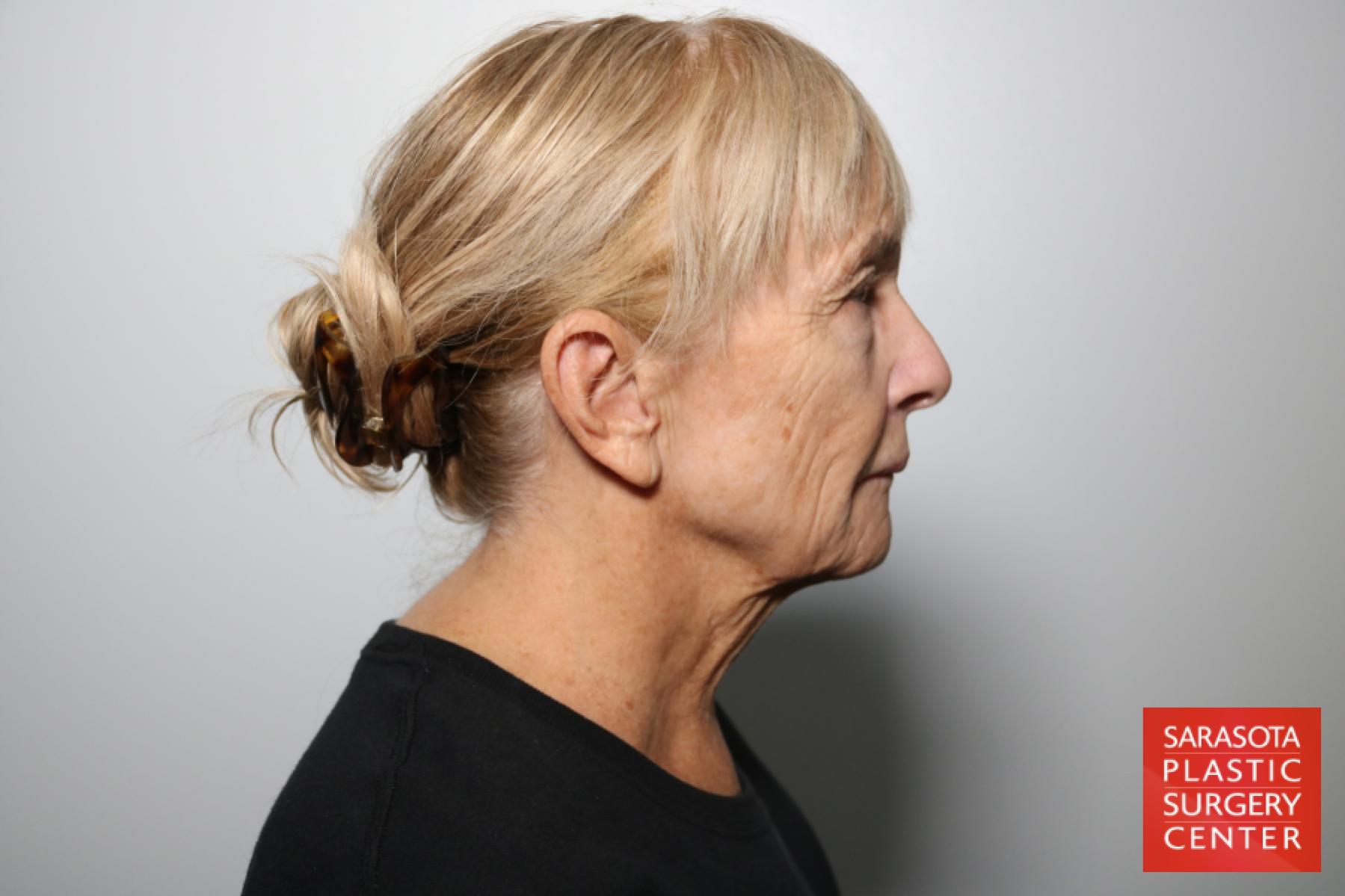 Facelift: Patient 46 - Before and After 5