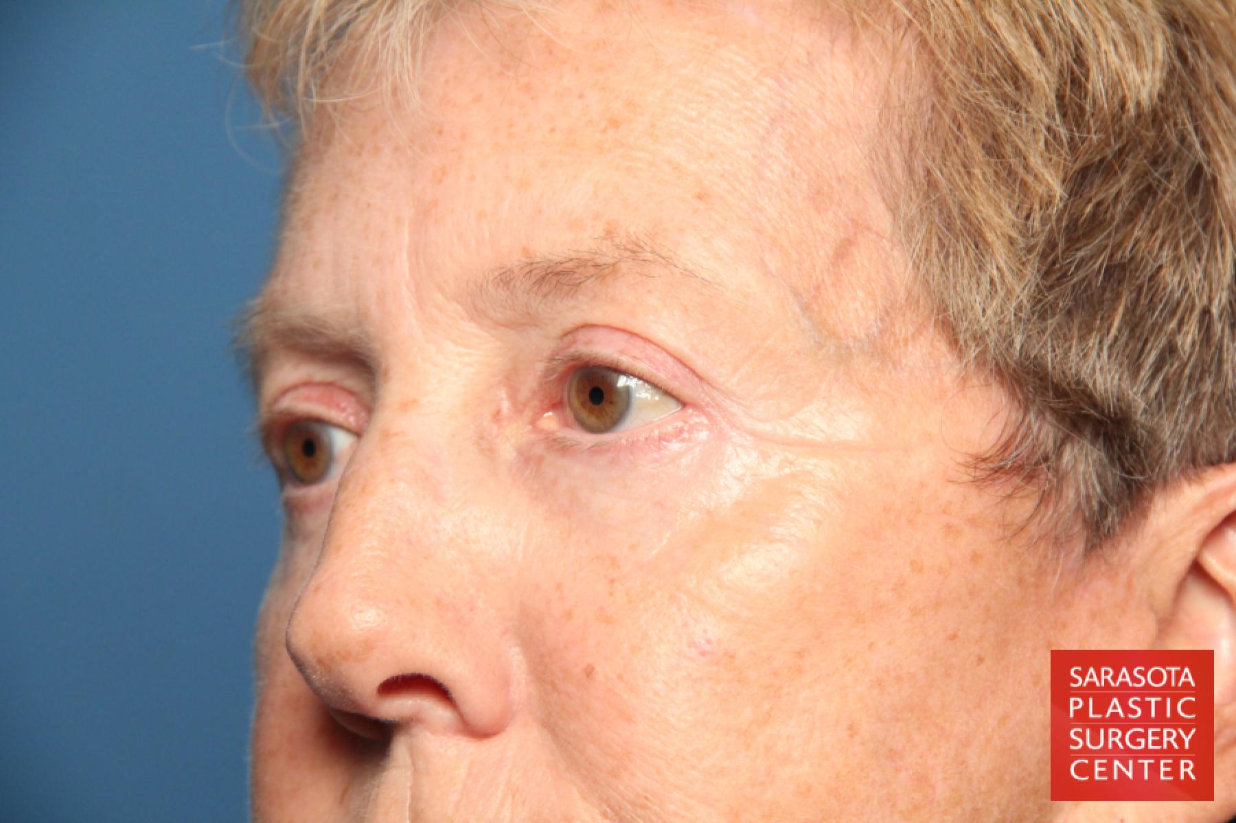 Eyelid Lift: Patient 22 - After 4