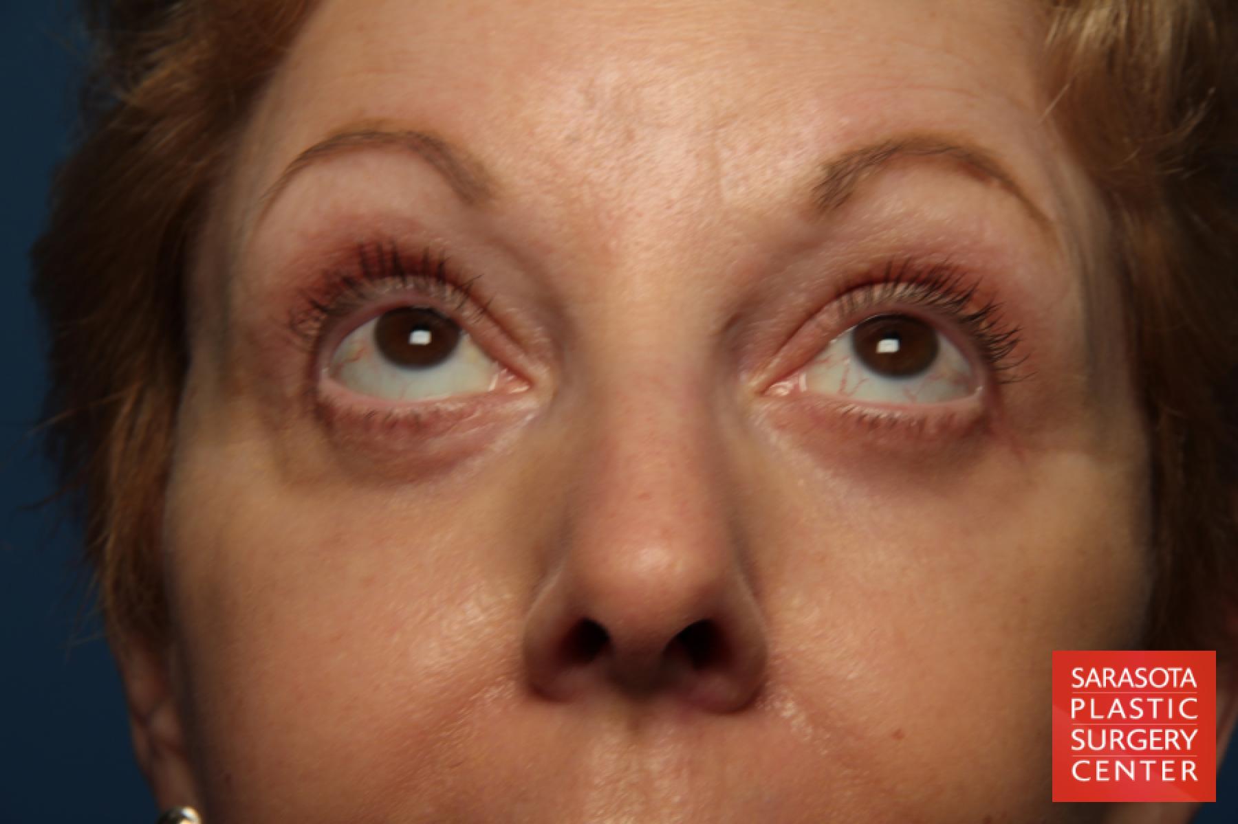 Eyelid Lift: Patient 41 - After 2