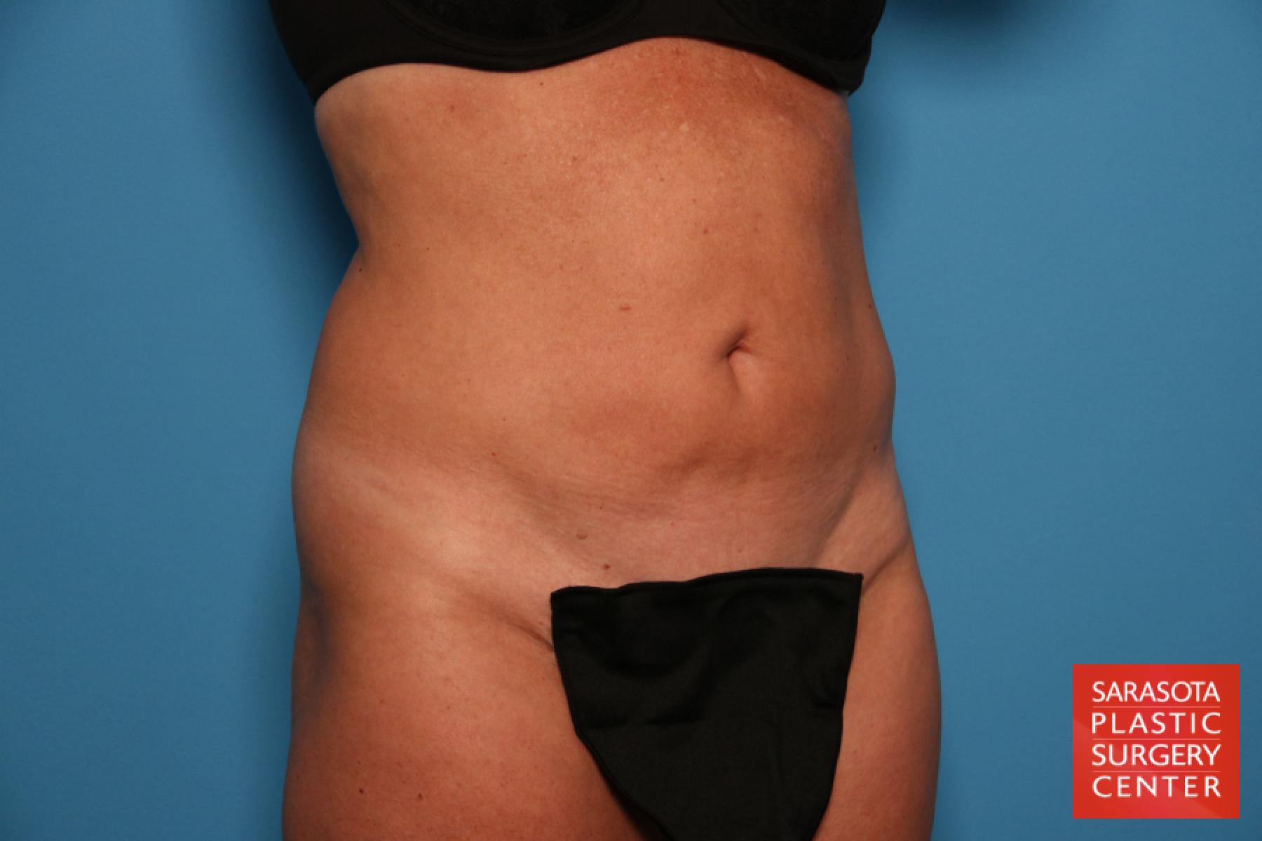 Tummy Tuck: Patient 10 - Before 2