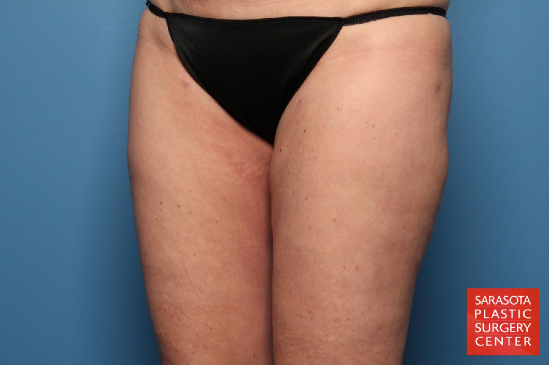 Liposuction: Patient 11 - After 2