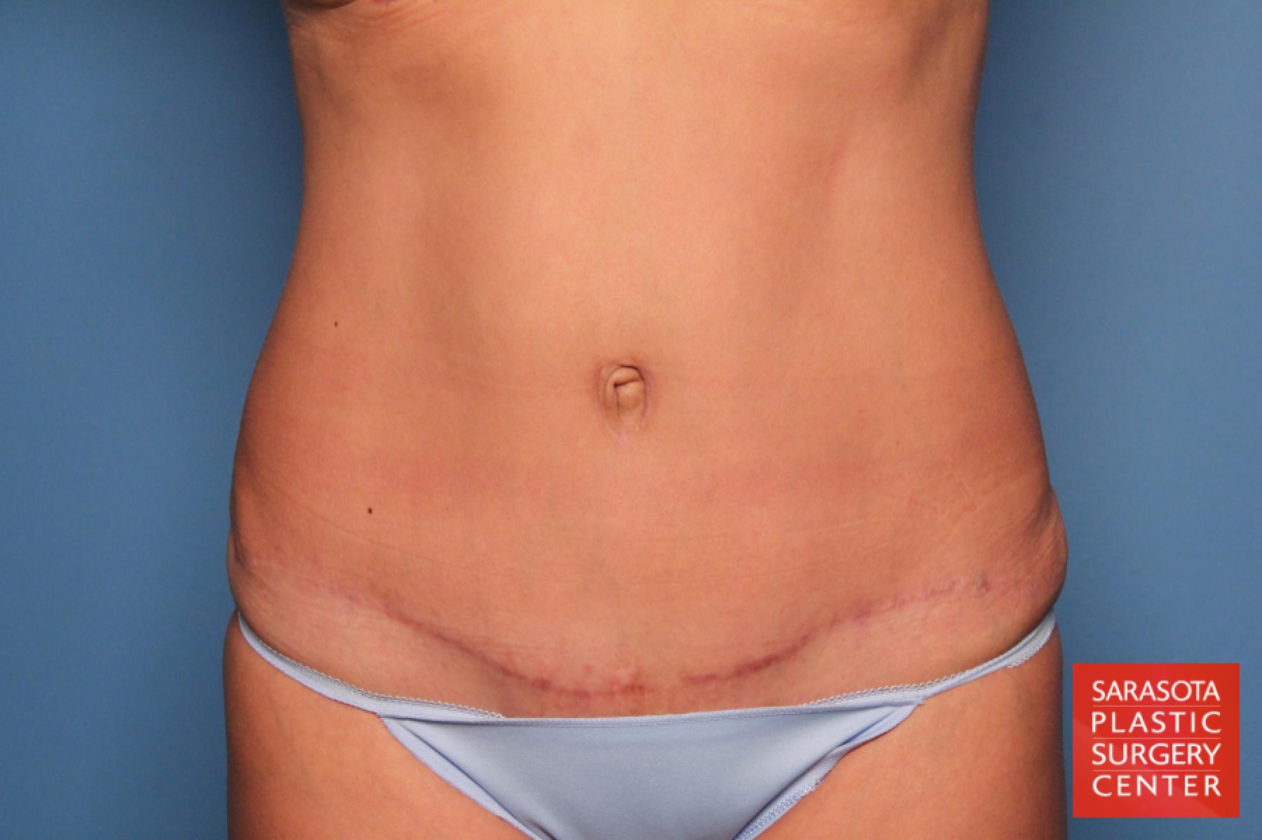 Tummy Tuck: Patient 12 - After 1
