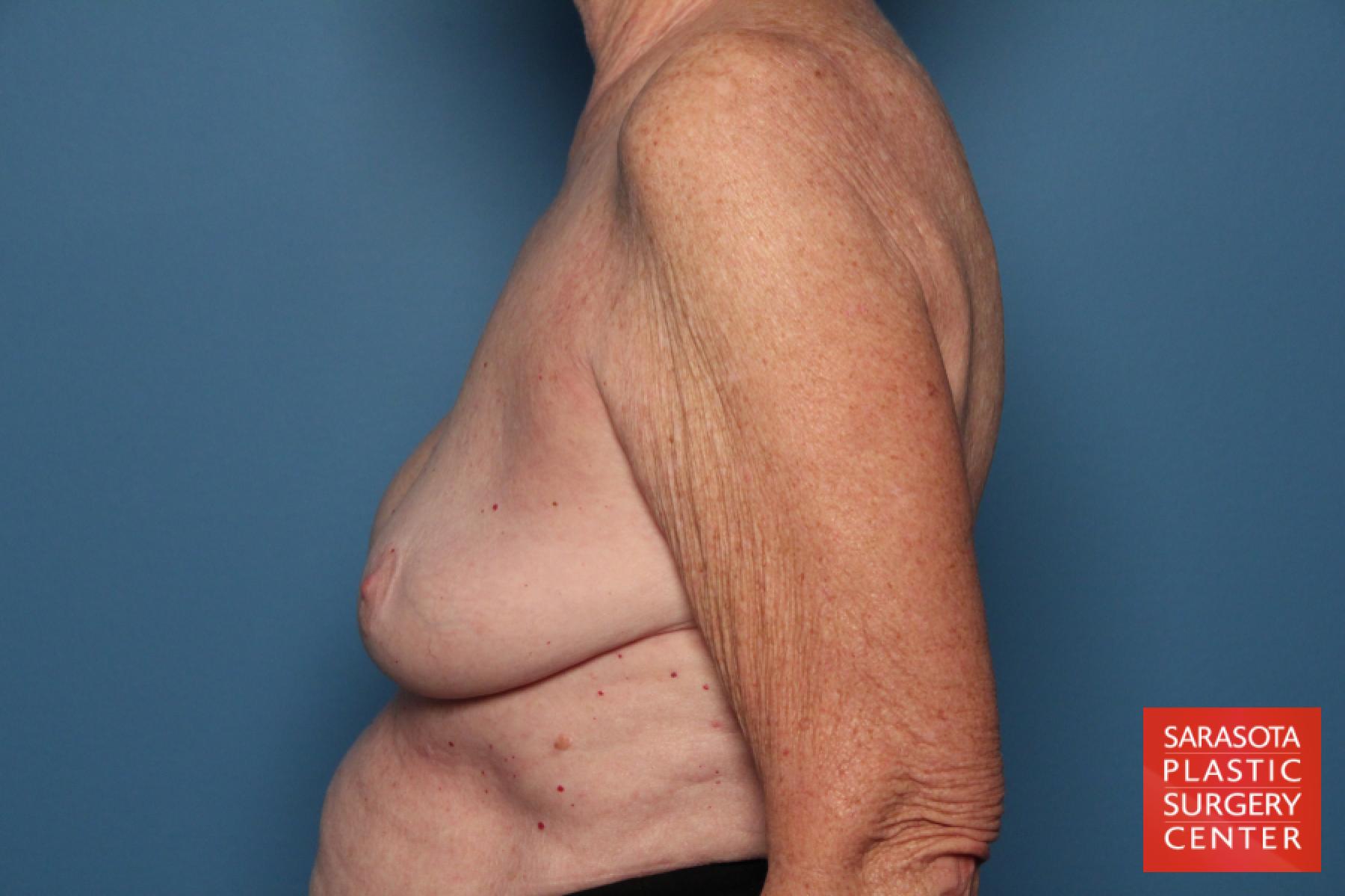 Breast Implant Exchange: Patient 7 - Before and After 3