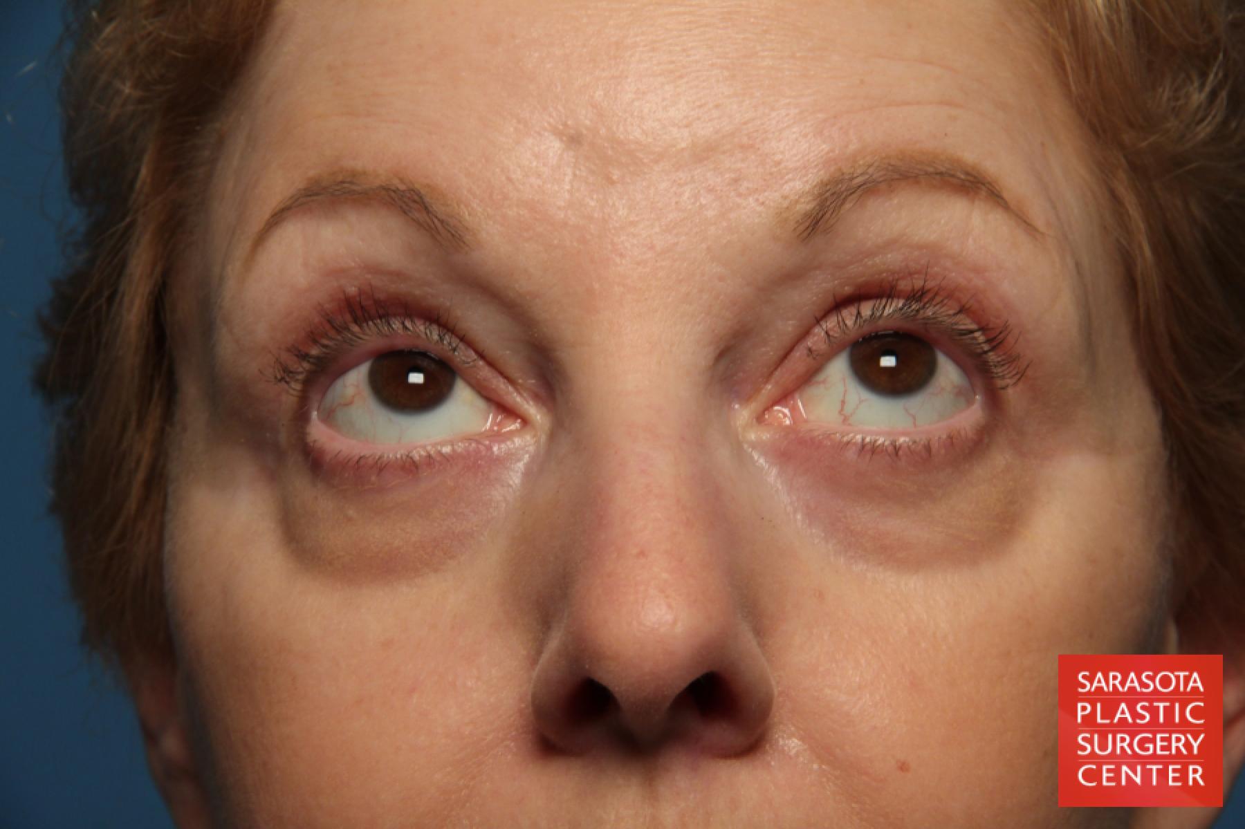 Eyelid Lift: Patient 41 - Before 2