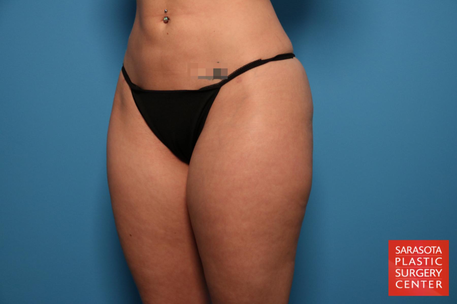 Liposuction: Patient 5 - Before 2