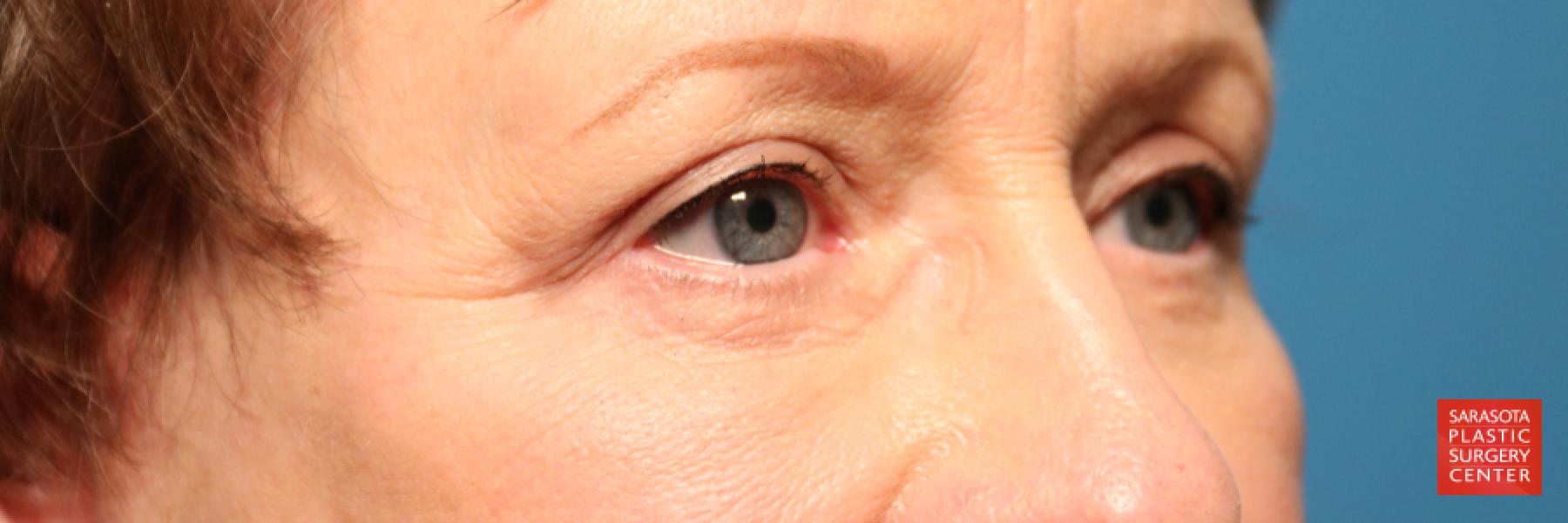 Eyelid Lift: Patient 20 - After 4