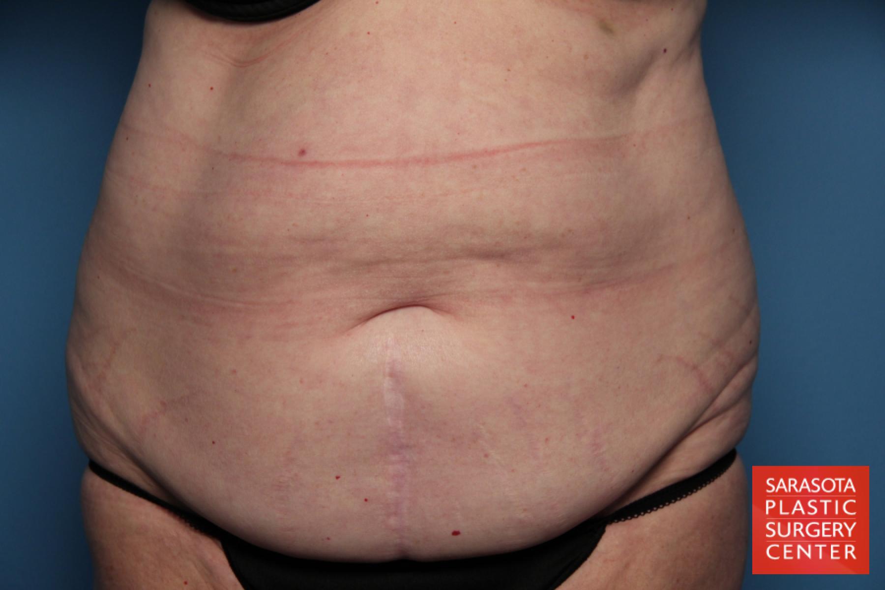 Tummy Tuck: Patient 15 - Before 1