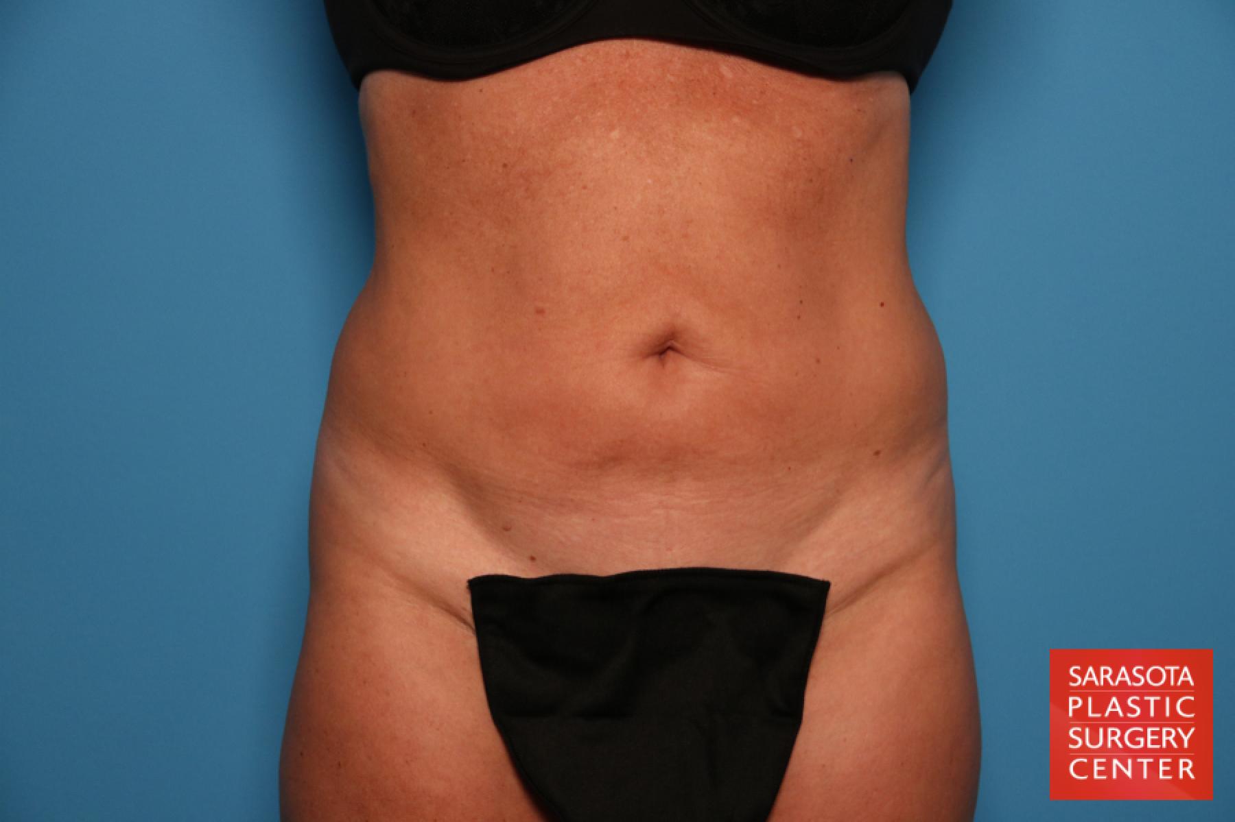 Tummy Tuck: Patient 10 - Before 