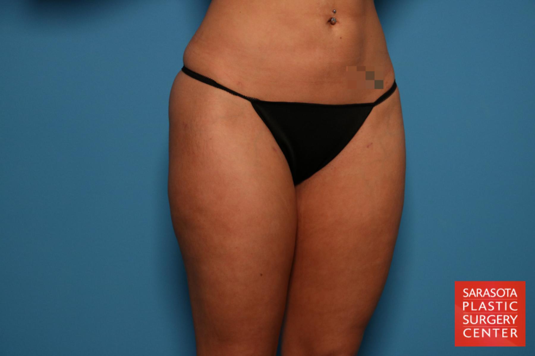 Liposuction: Patient 5 - After 3