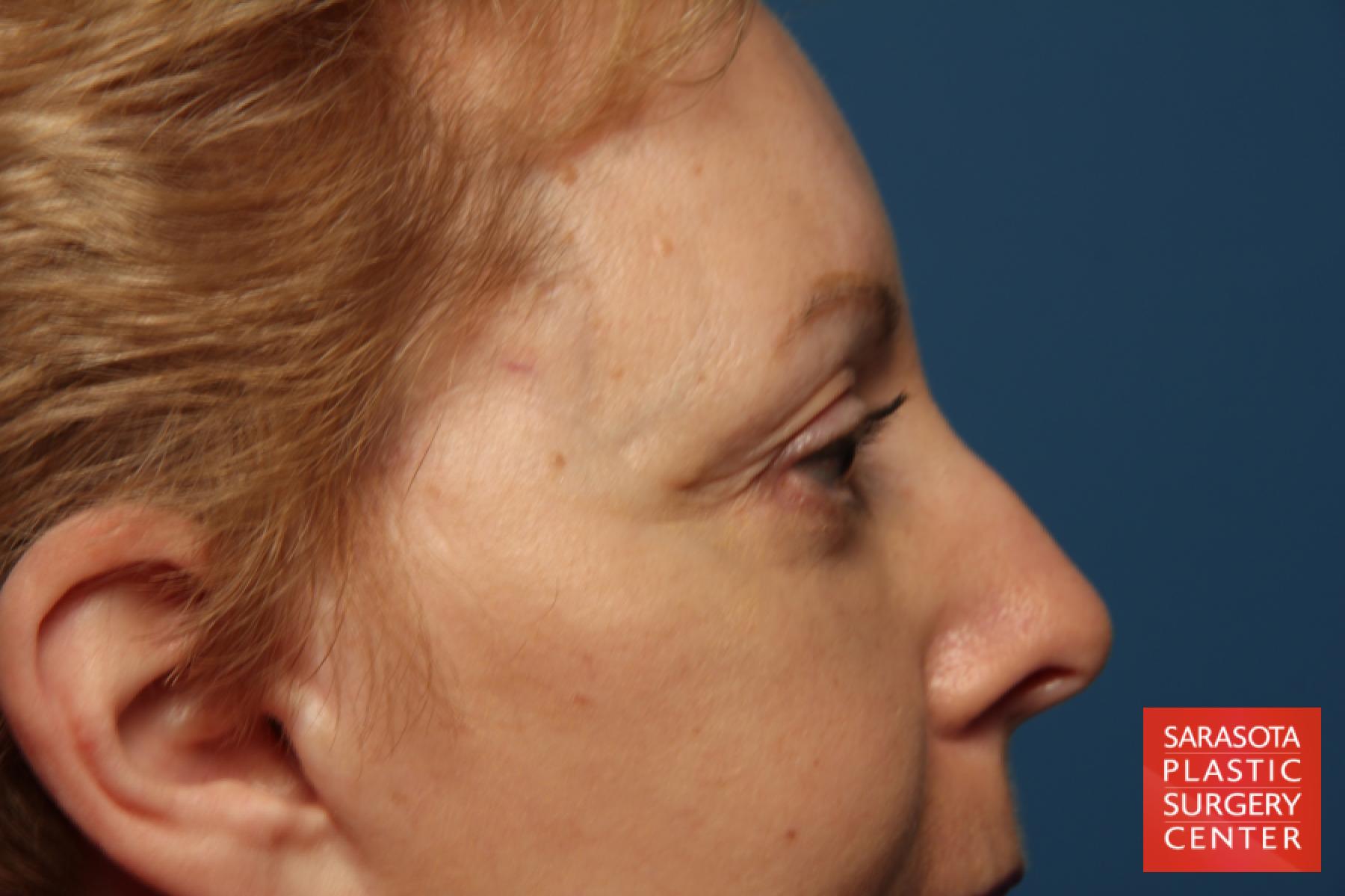 Eyelid Lift: Patient 41 - After 6