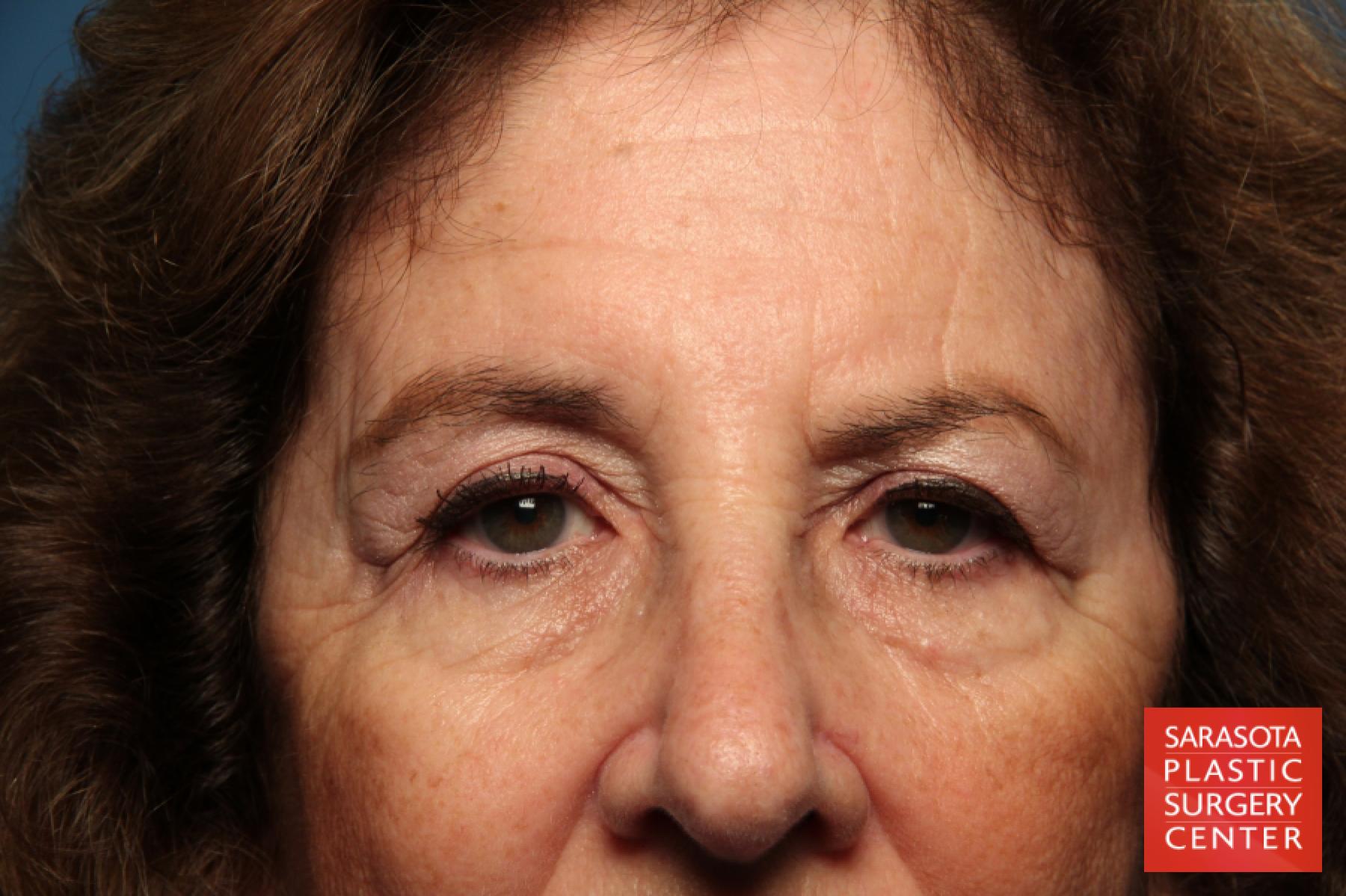 Eyelid Lift: Patient 42 - Before 1
