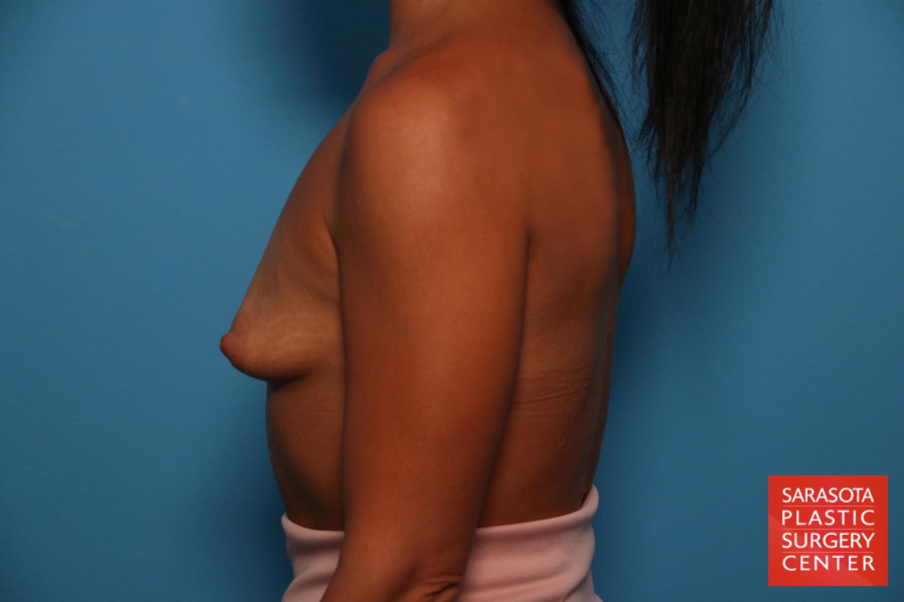 Breast Augmentation With Lift: Patient 35 - Before and After 3
