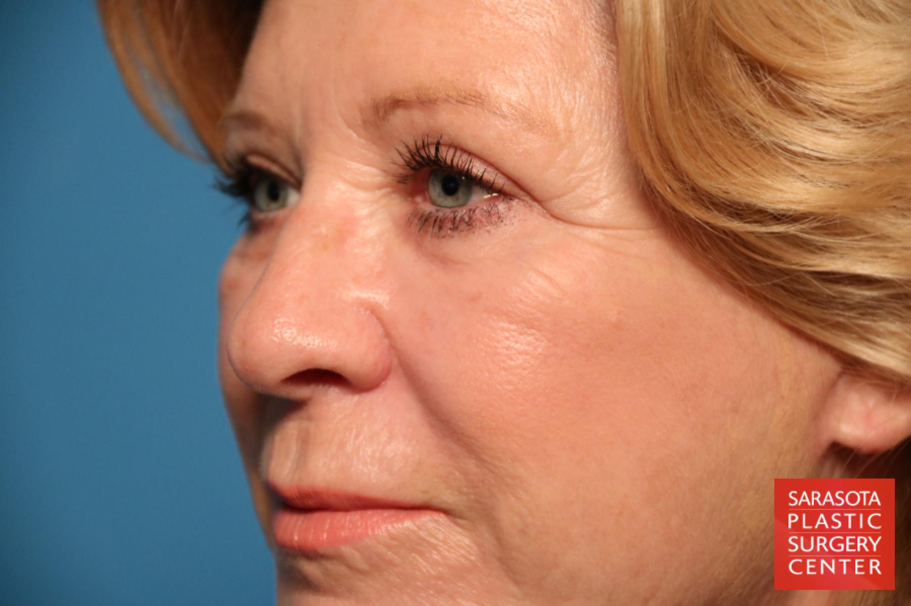 Laser Skin Resurfacing - Face: Patient 10 - After 2
