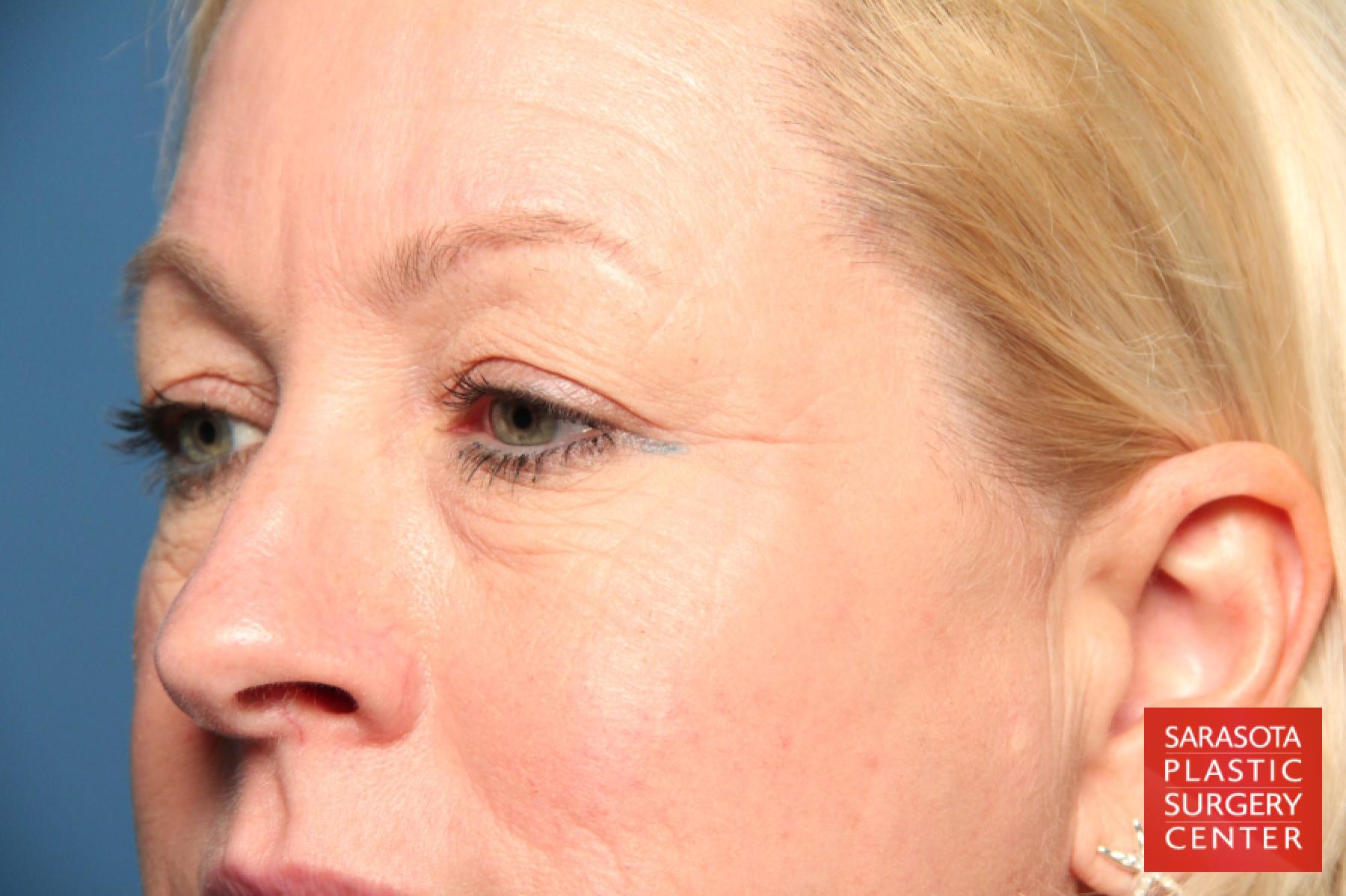 Eyelid Lift: Patient 4 - Before 2