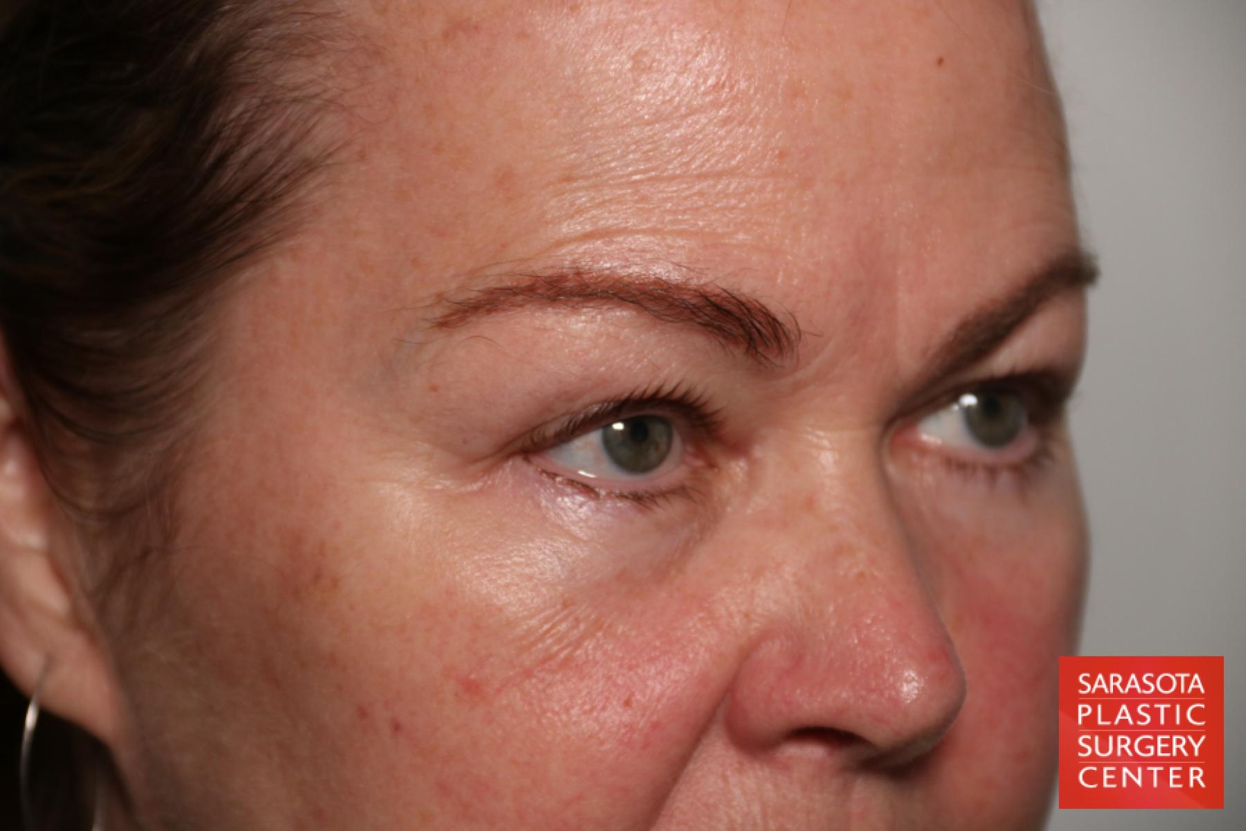 Eyelid Lift: Patient 44 - Before 4
