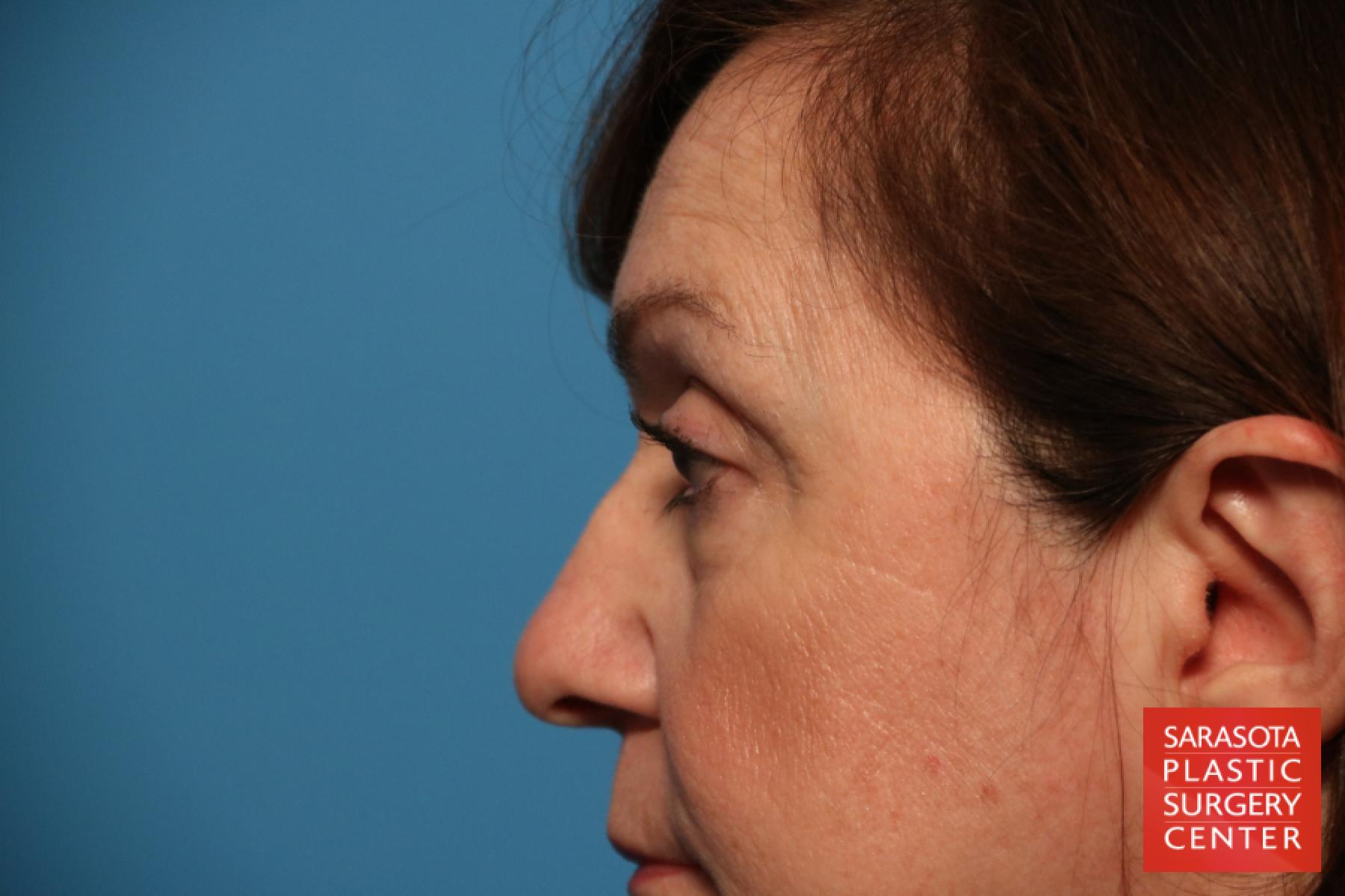 Eyelid Lift: Patient 31 - Before 4