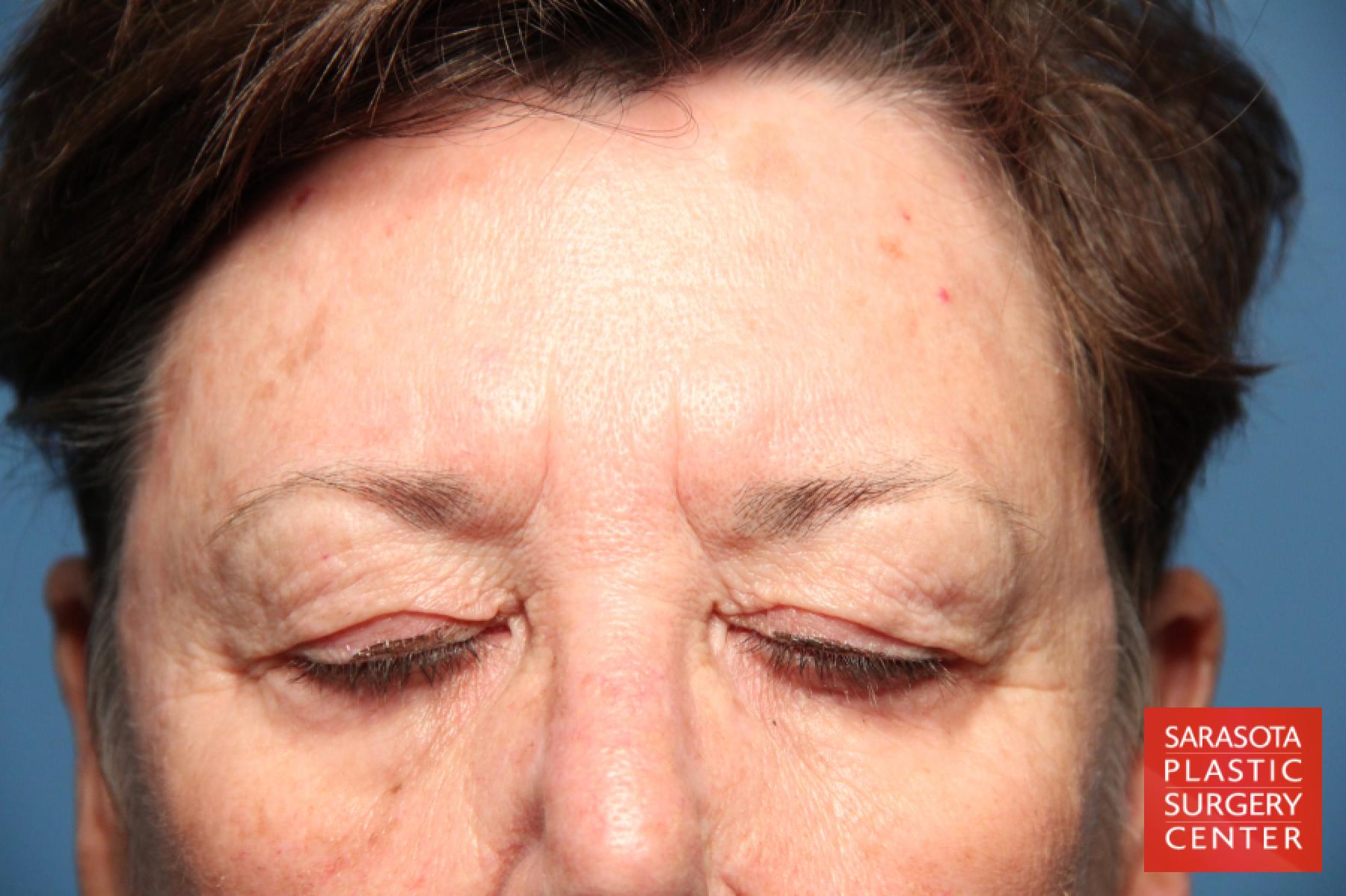 Eyelid Lift: Patient 17 - Before 2