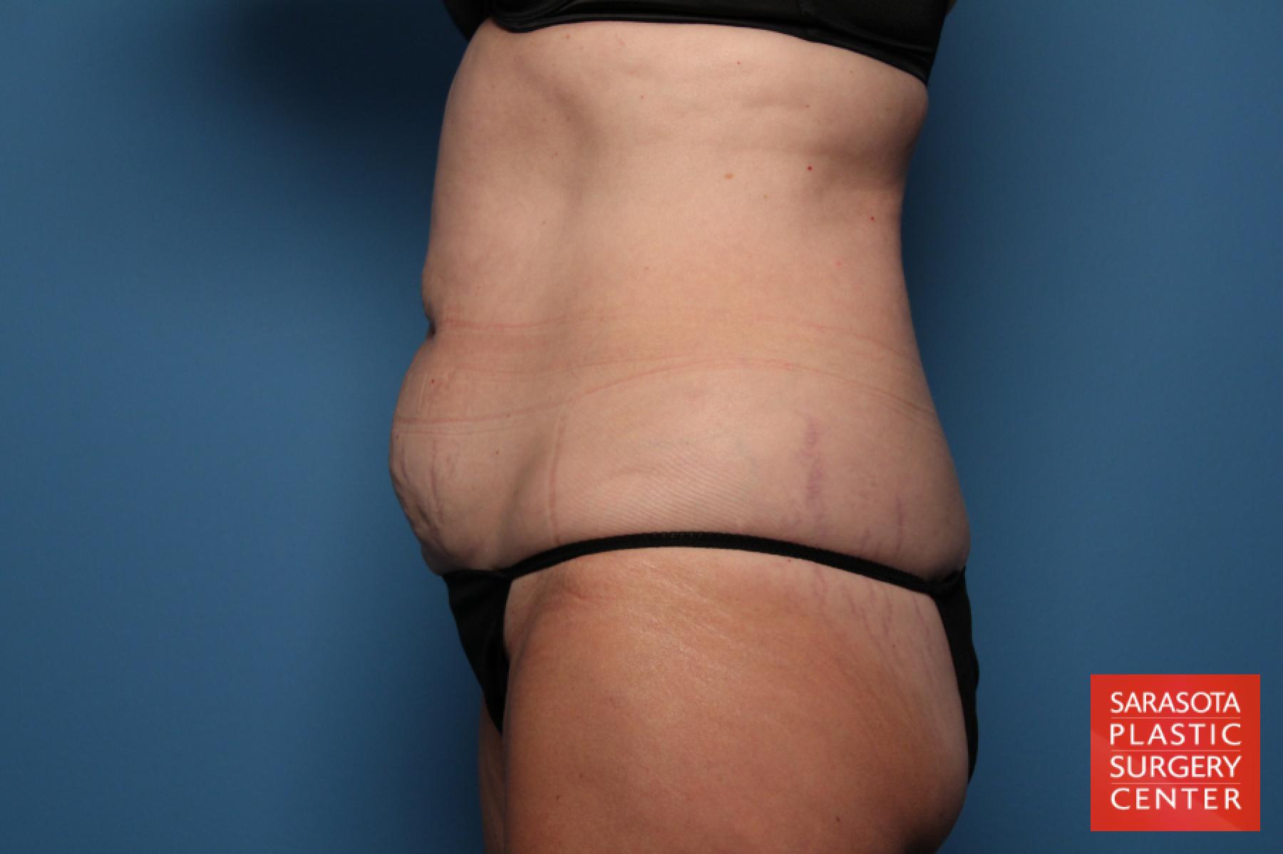Tummy Tuck: Patient 18 - Before 3