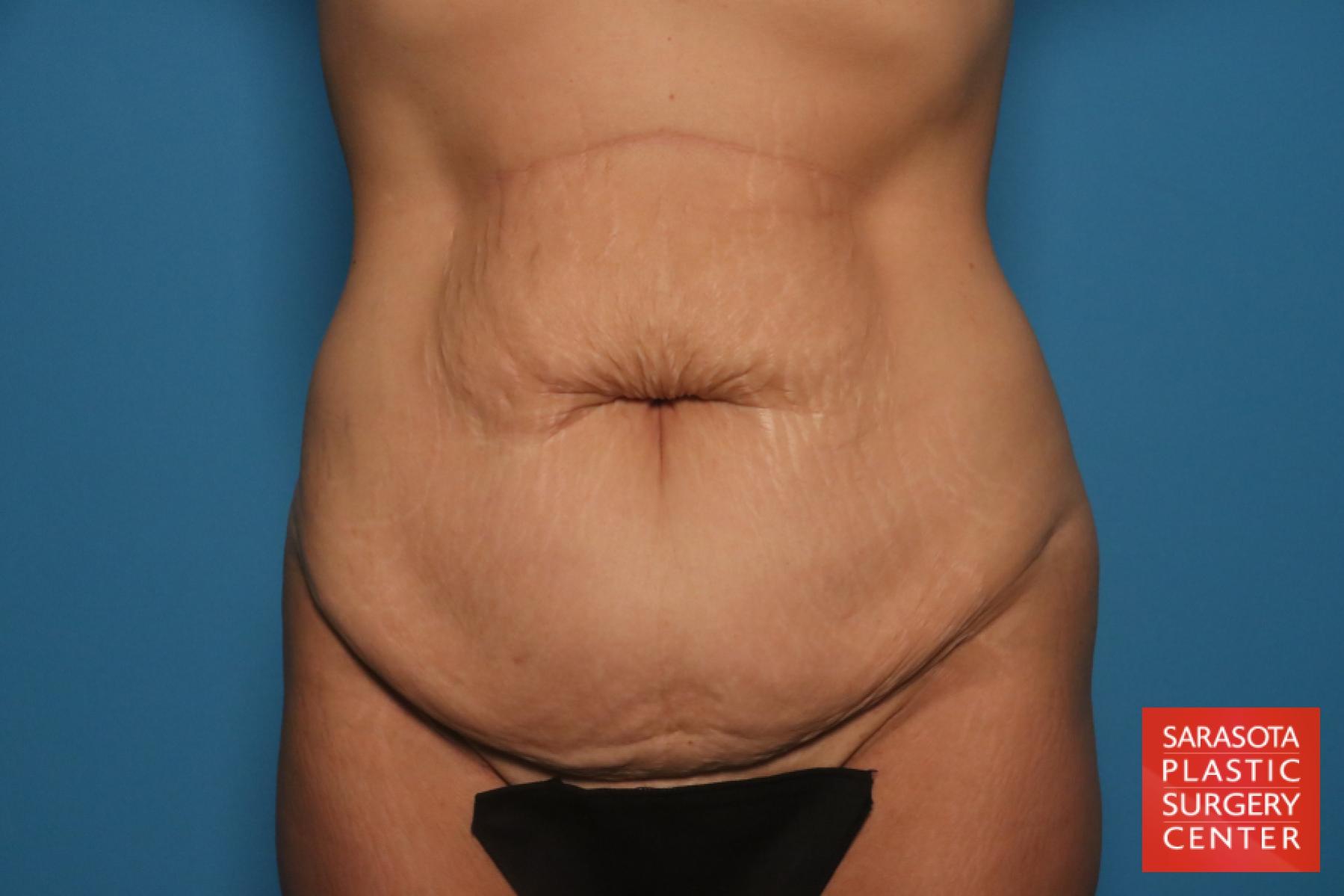 Tummy Tuck: Patient 26 - Before 1