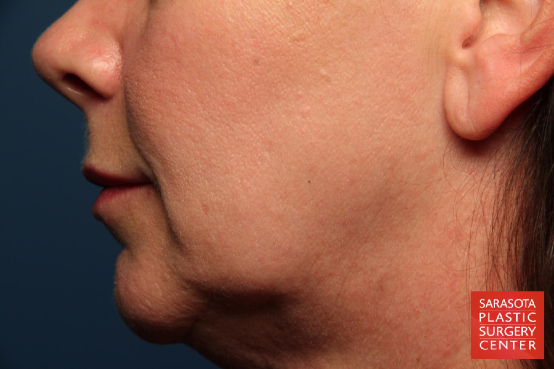 Fat Transfer   Face Revision: Patient 1 - Before 3
