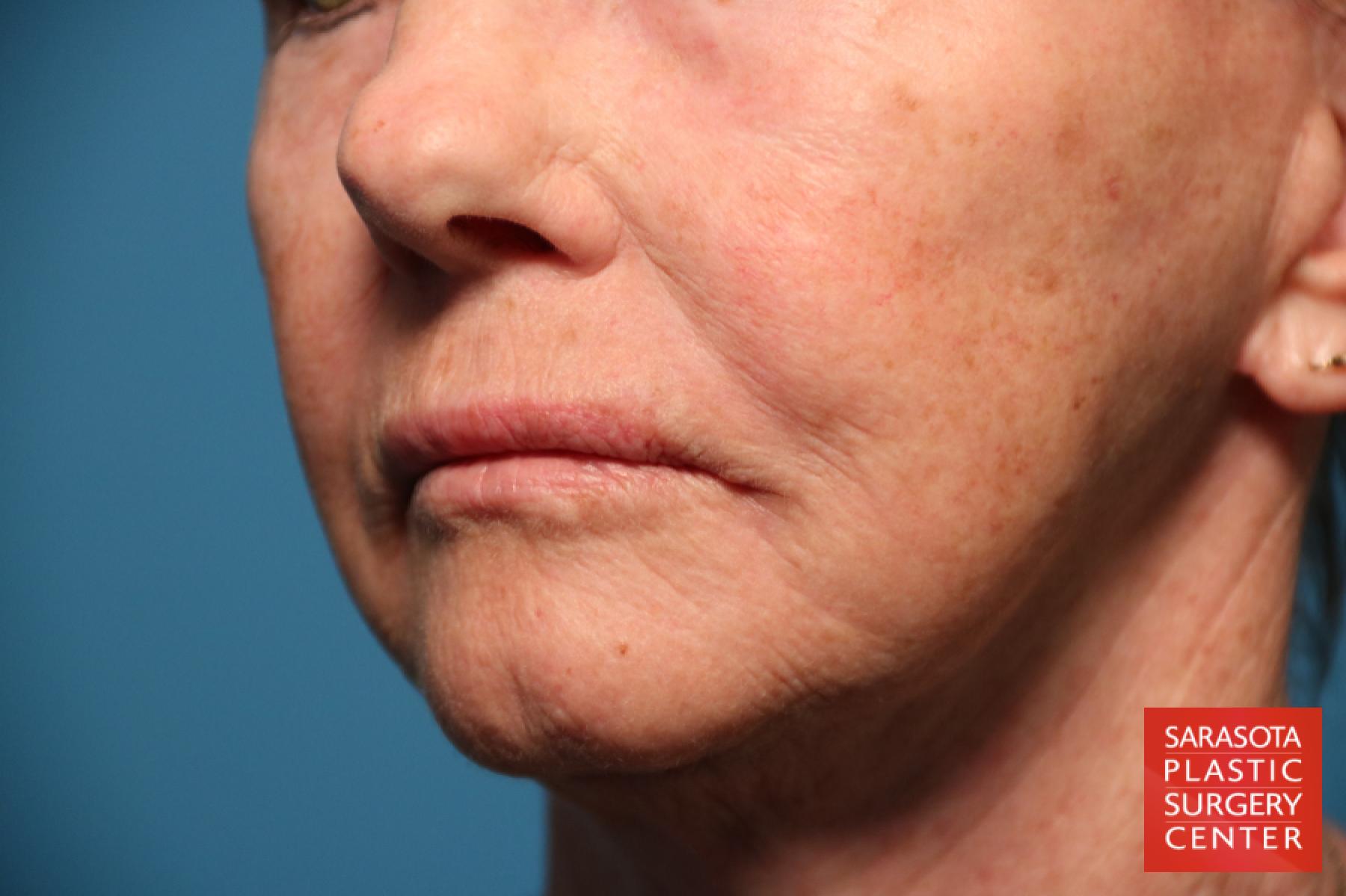 Laser Skin Resurfacing - Face: Patient 14 - After 2
