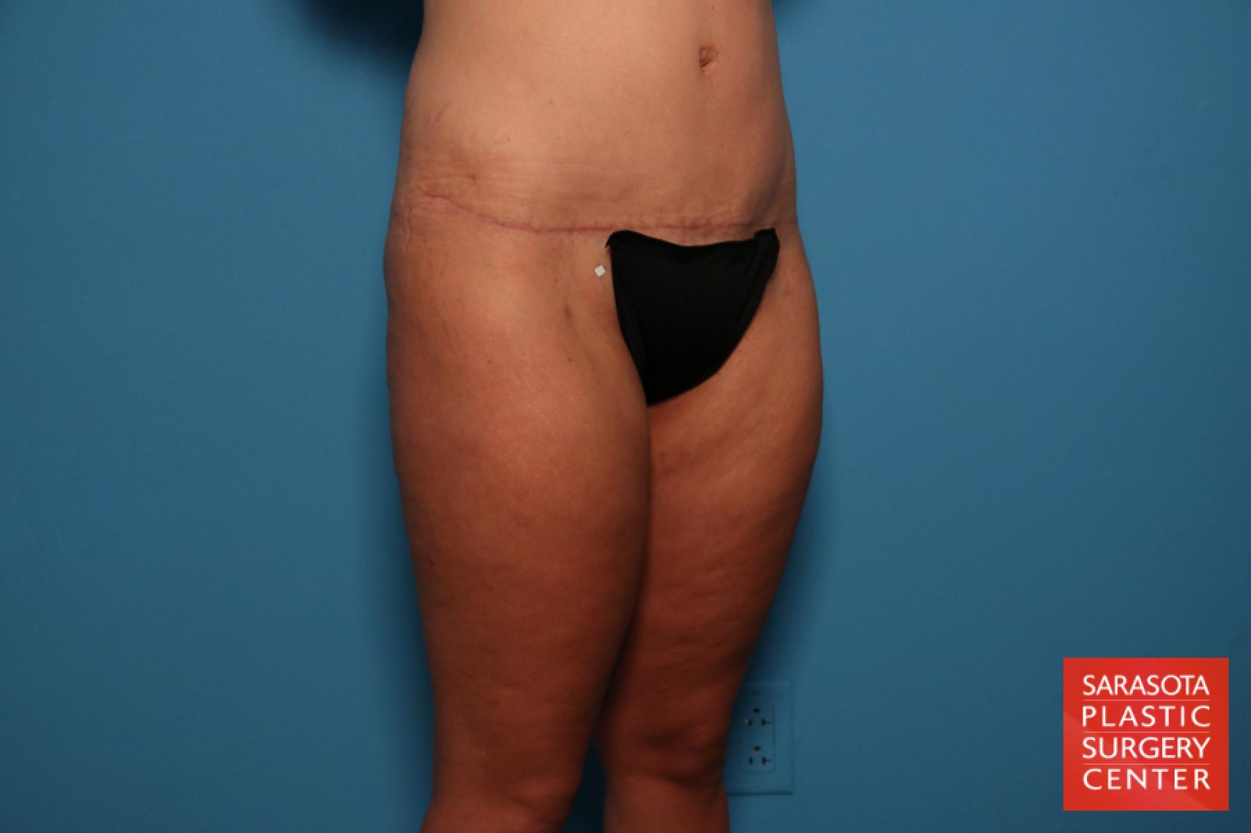 Liposuction: Patient 7 - After 6