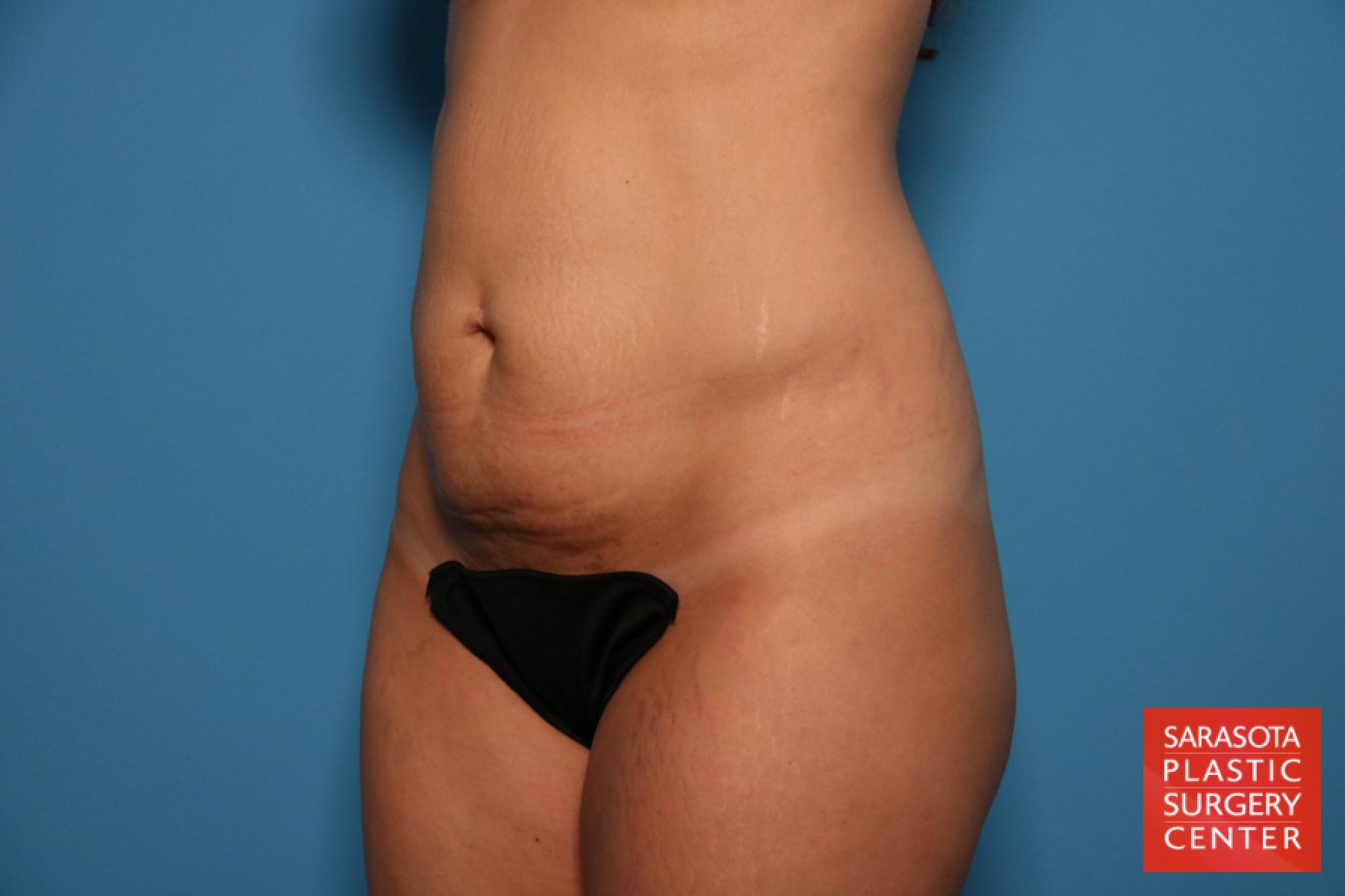 Tummy Tuck: Patient 7 - Before 2