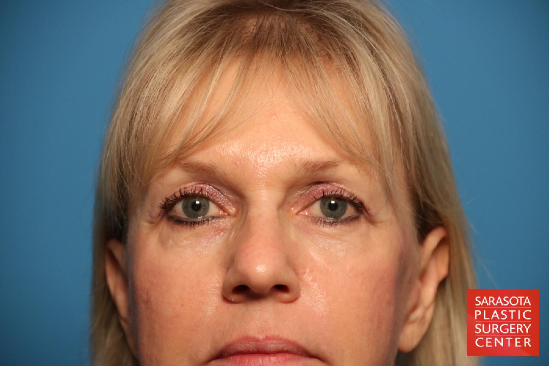 Eyelid Lift: Patient 7 - Before 