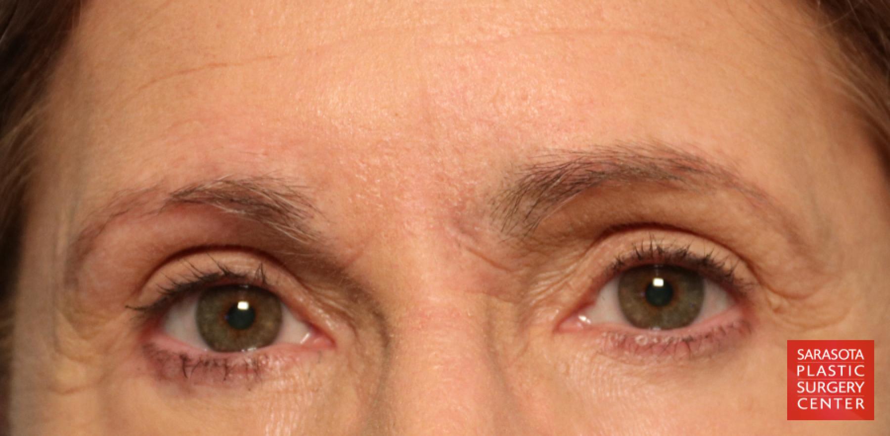 Brow Lift: Patient 1 - After 1