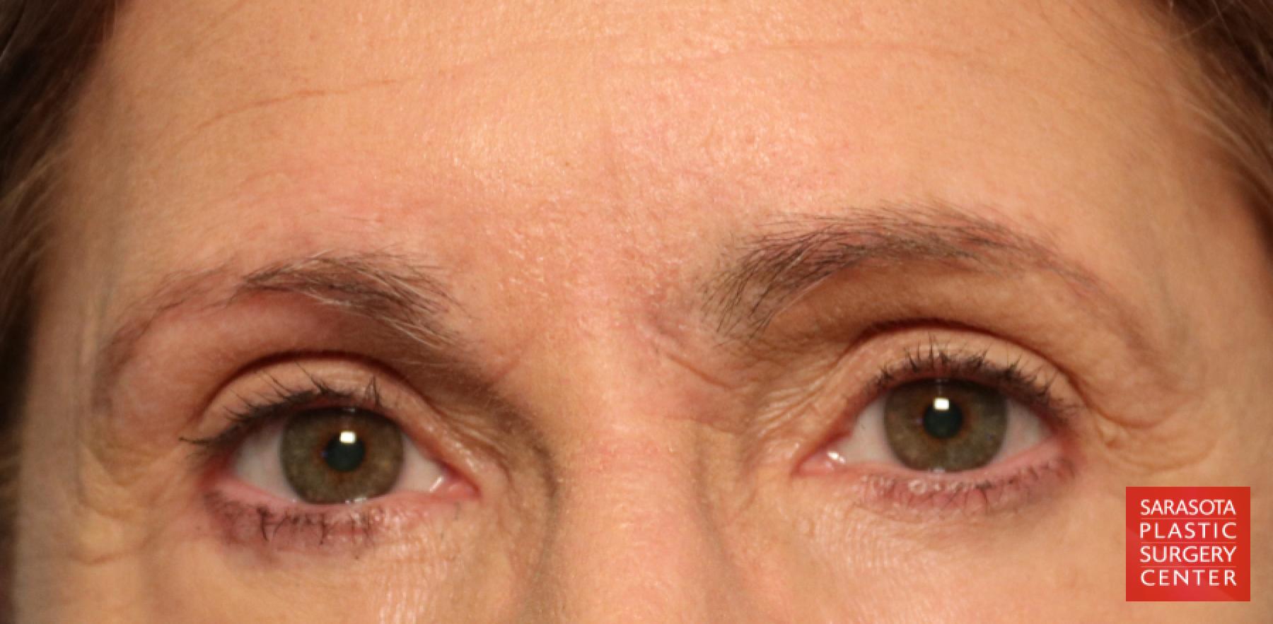 Brow Lift: Patient 1 - After  