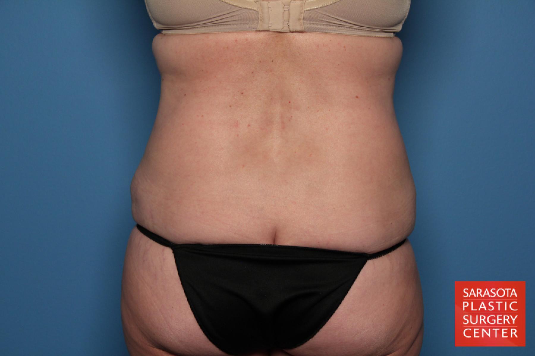 Tummy Tuck: Patient 18 - After 5