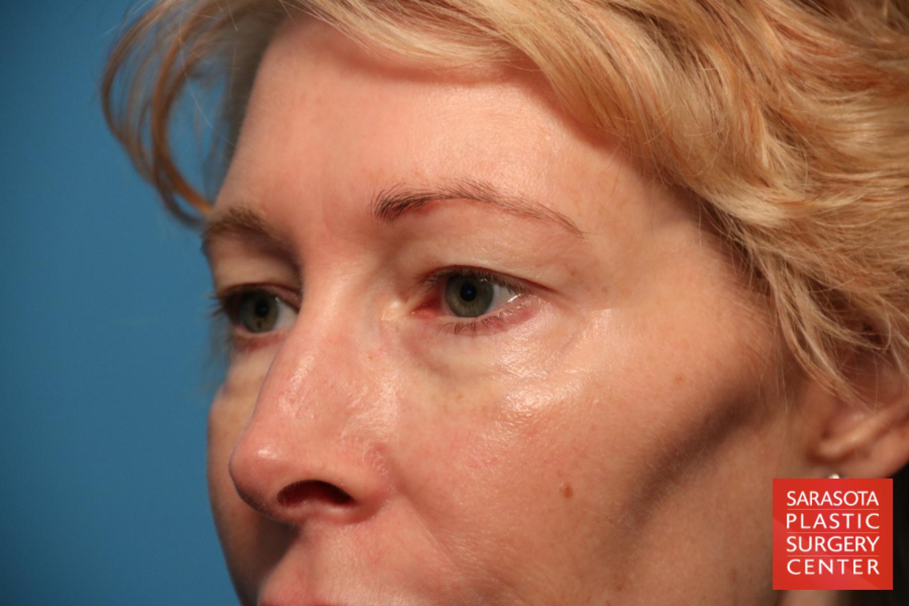 Eyelid Lift: Patient 12 - Before 3