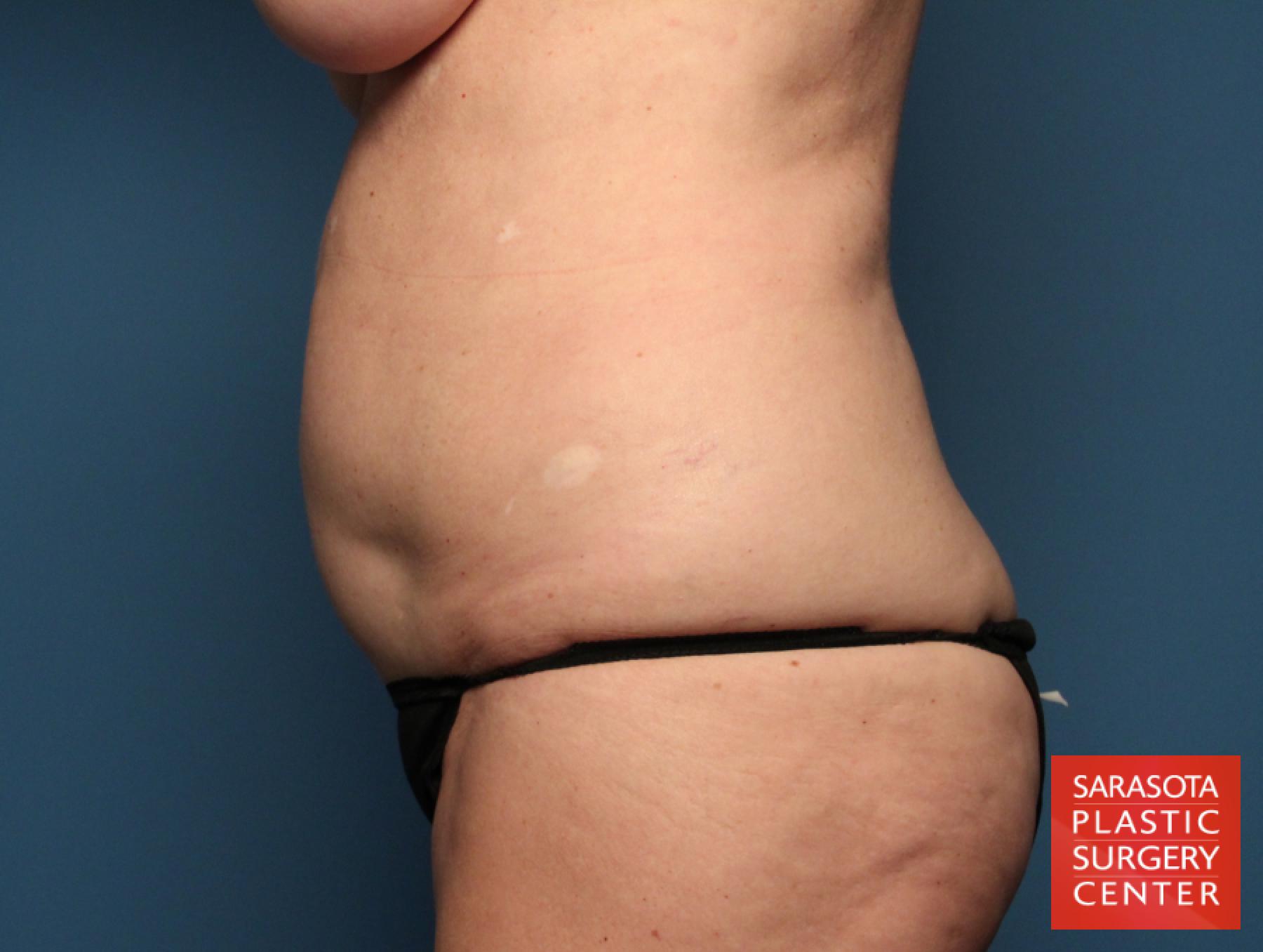 Tummy Tuck: Patient 19 - Before and After 3