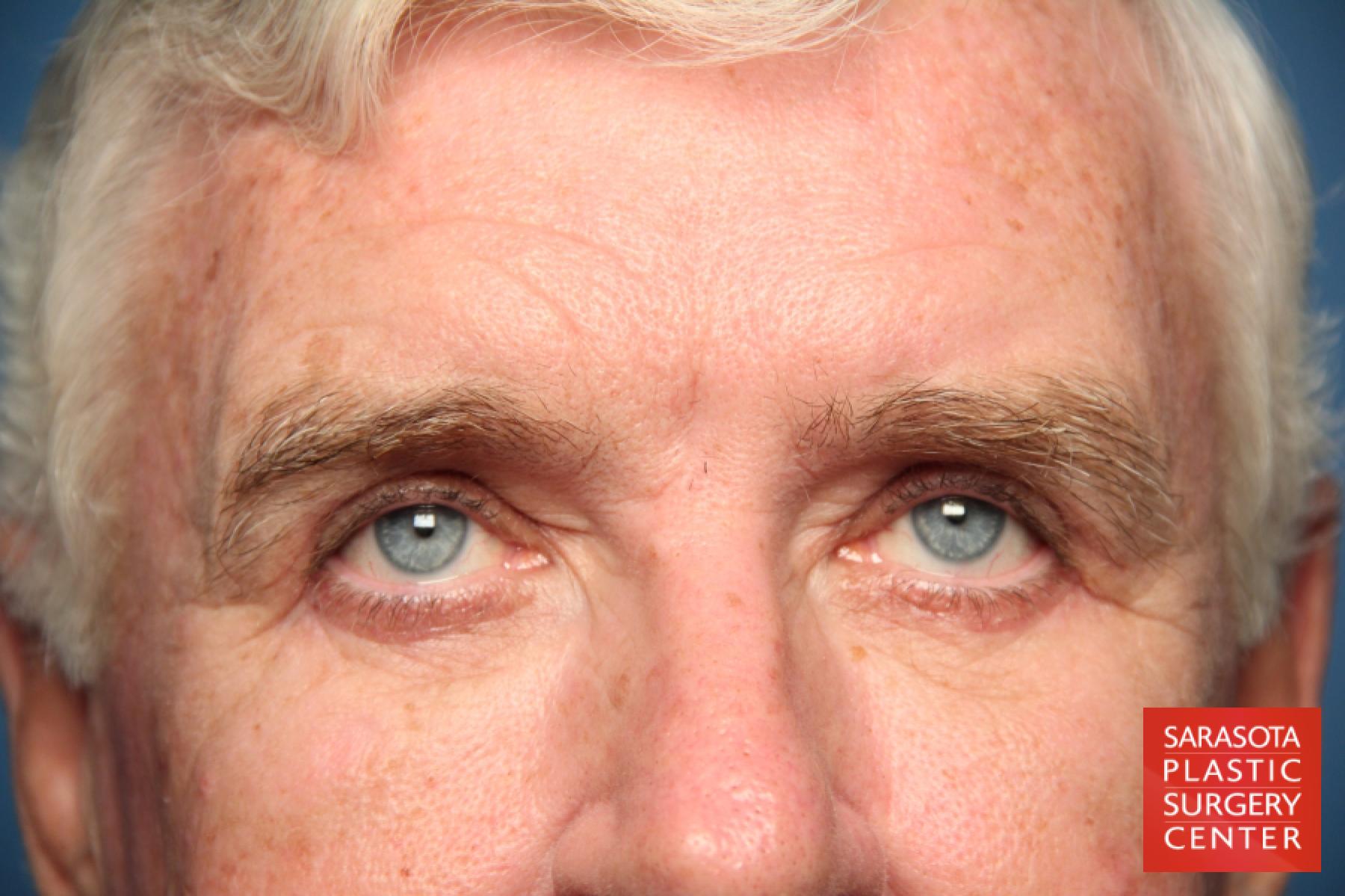 Eyelid Lift For Men: Patient 1 - After 4