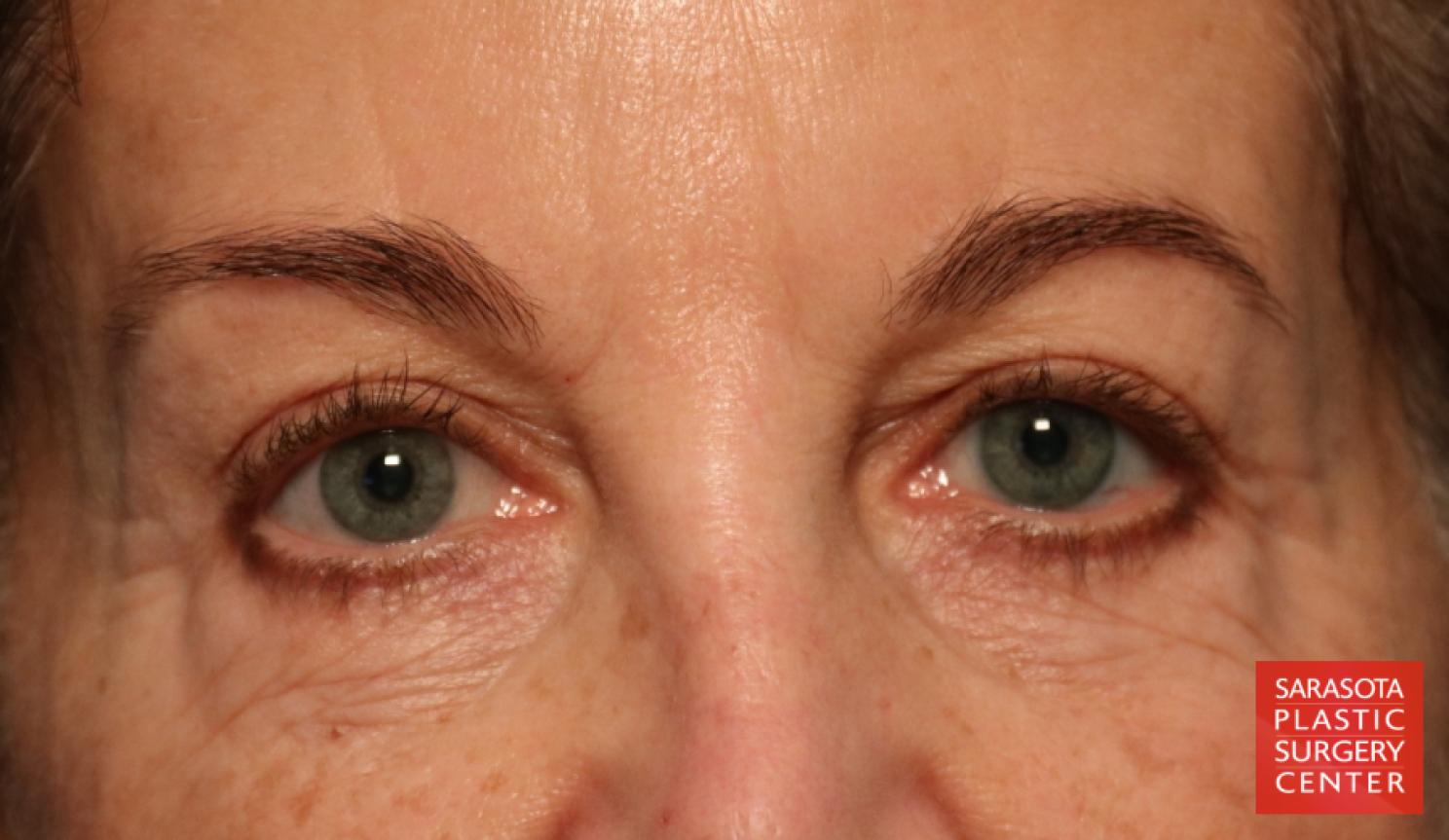 Eyelid Lift: Patient 39 - Before 1
