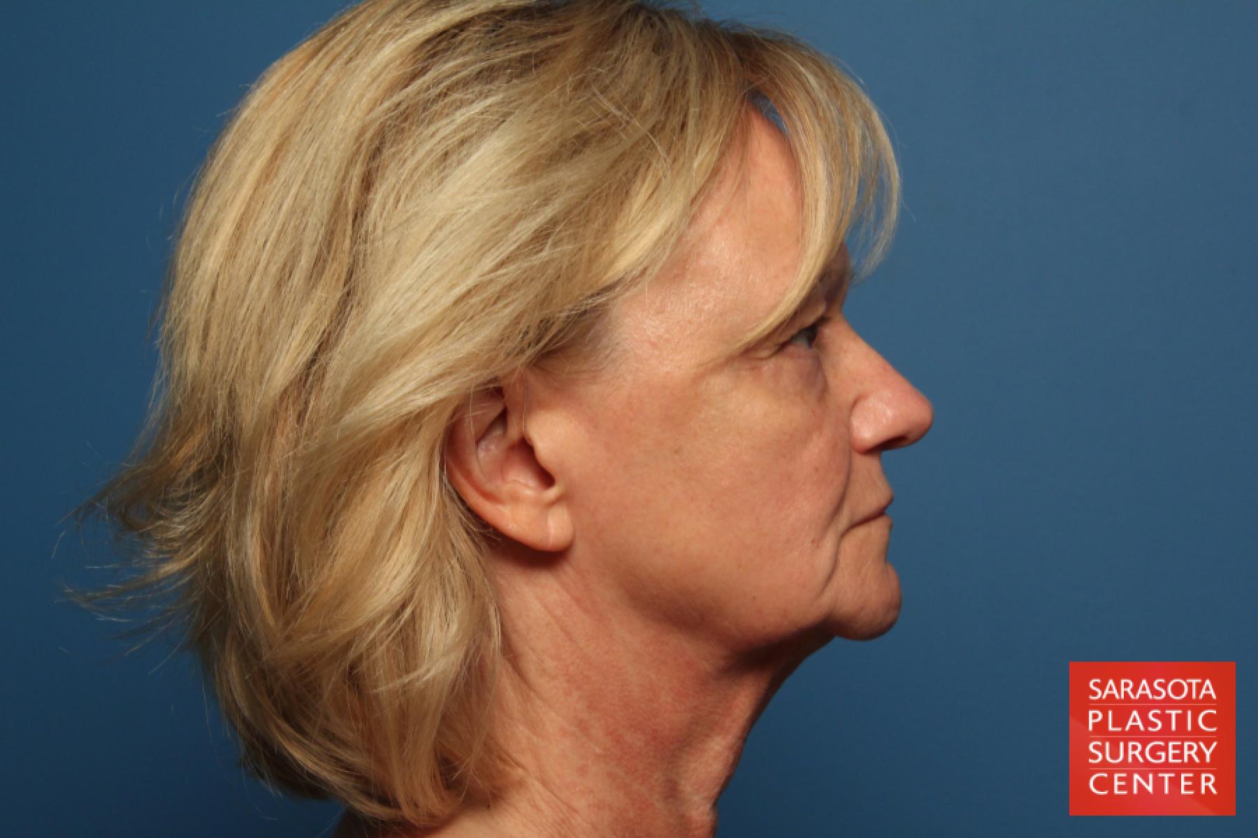 Facelift: Patient 27 - Before and After 3