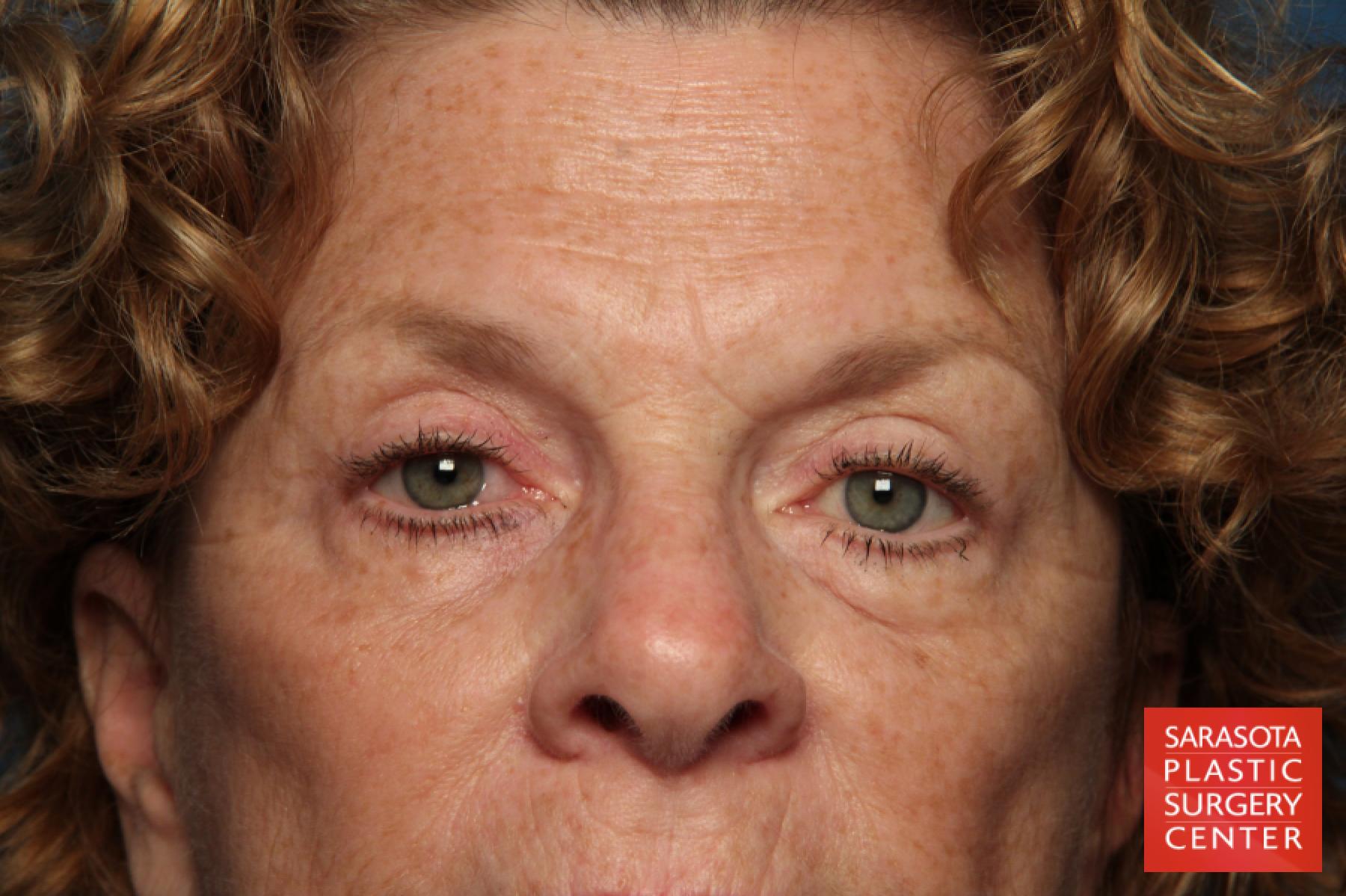 Eyelid Lift: Patient 25 - Before 1