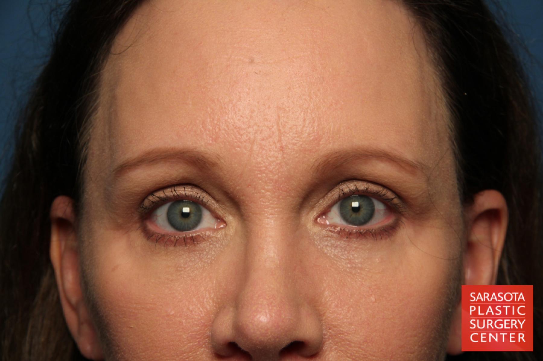 Eyelid Lift: Patient 40 - After 1