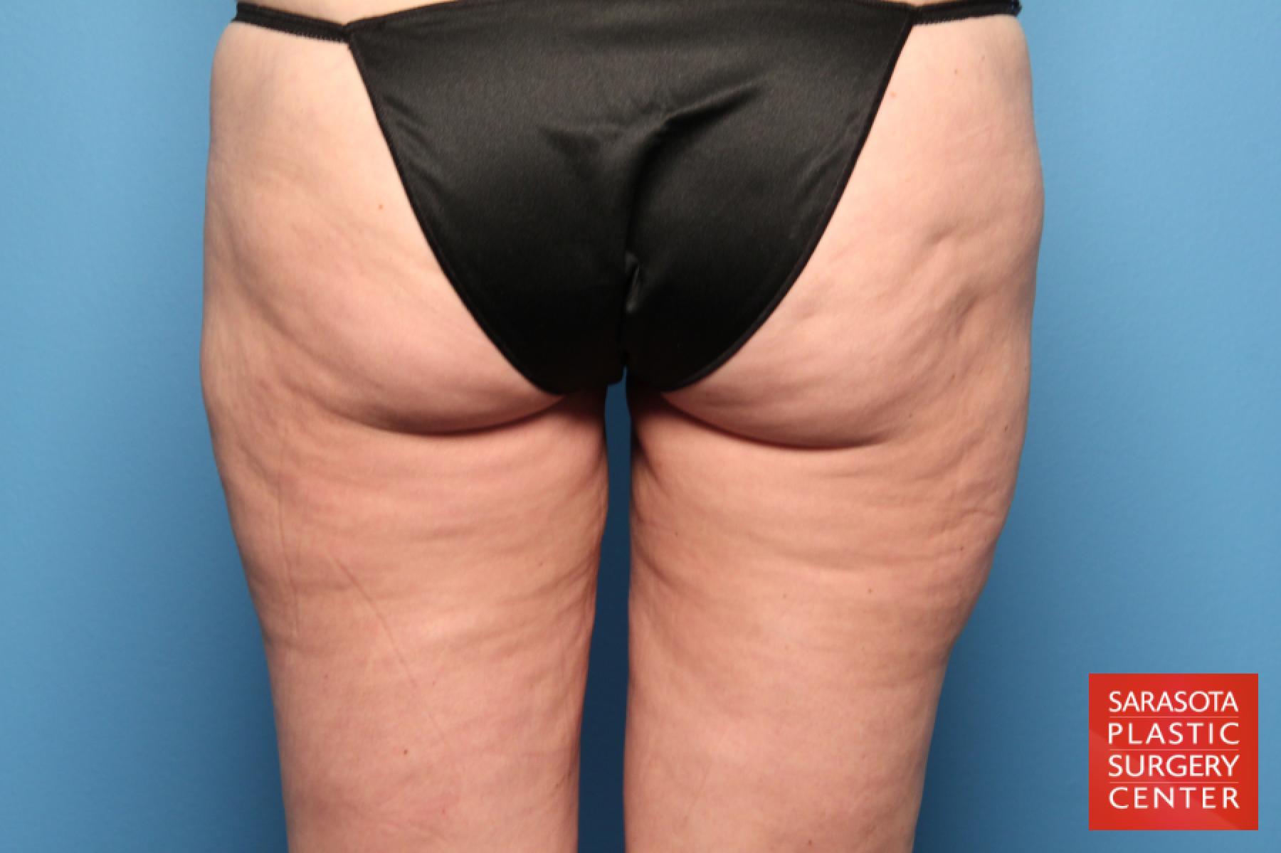 Liposuction: Patient 8 - After 4