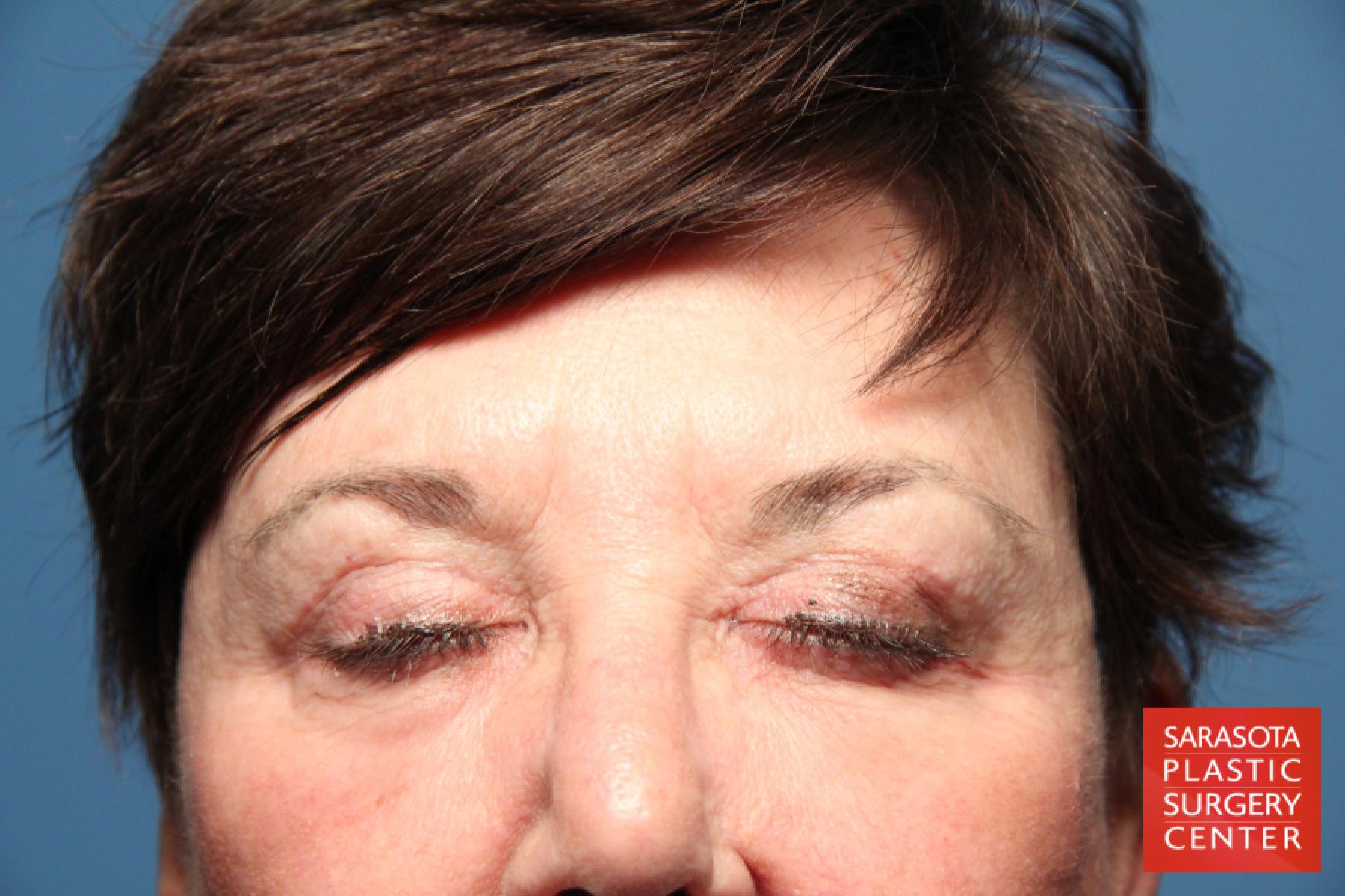 Eyelid Lift: Patient 17 - After 2