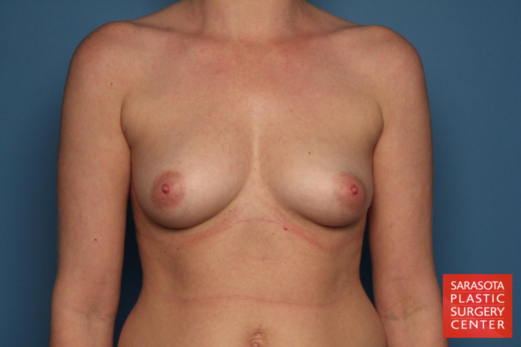 Breast Augmentation: Patient 63 - Before 1