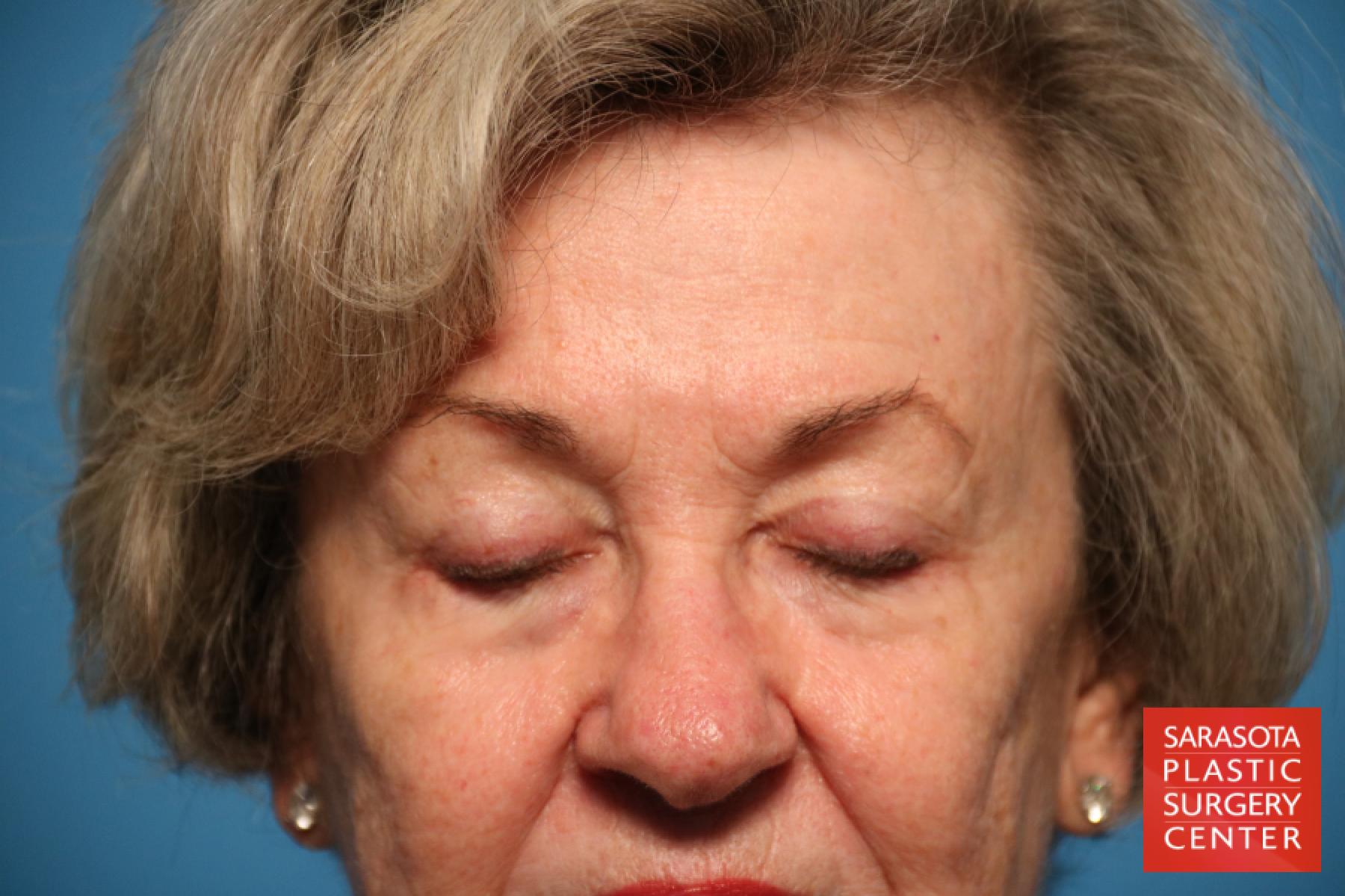 Eyelid Lift: Patient 13 - Before 2