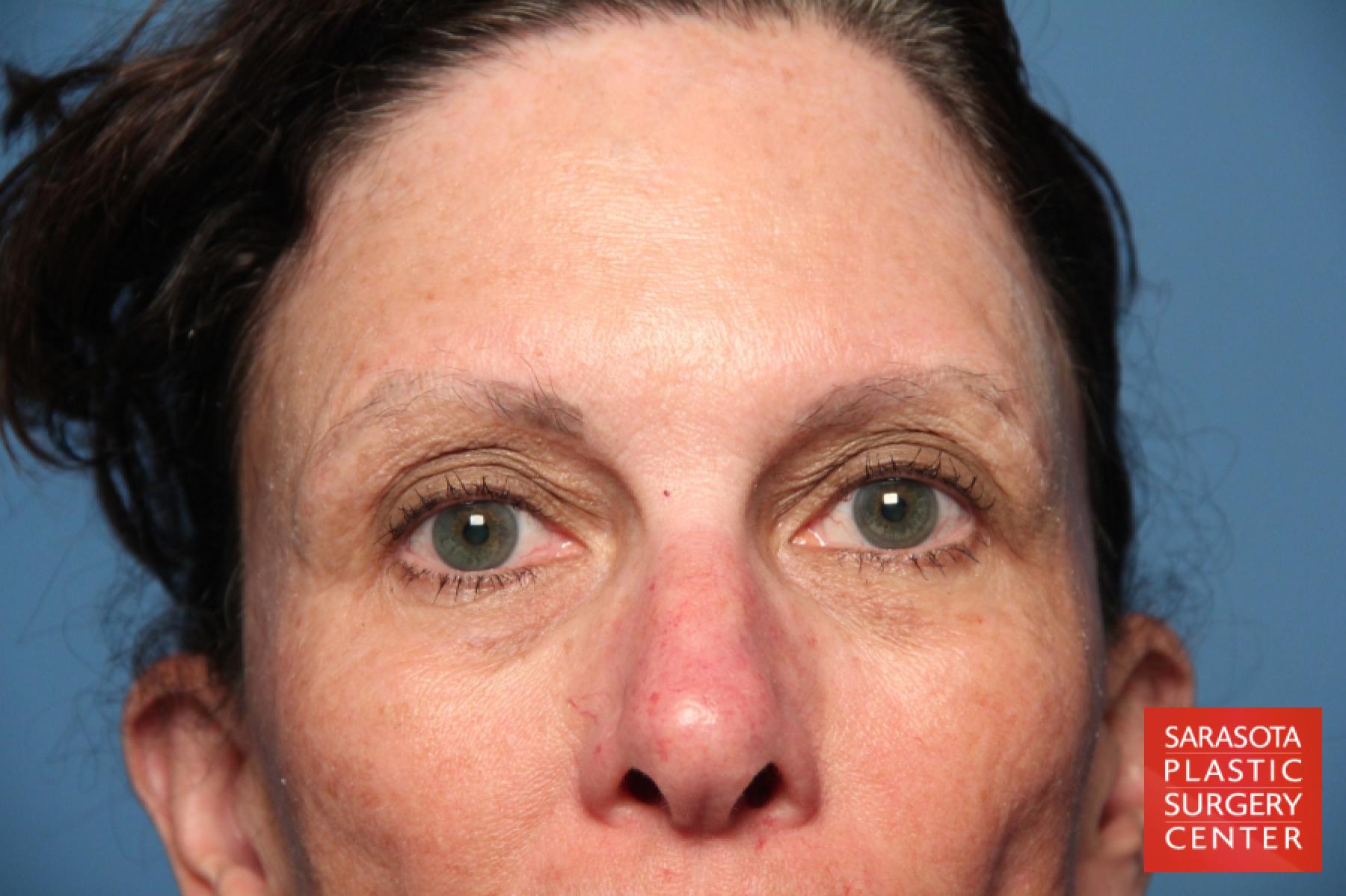 Eyelid Lift: Patient 8 - Before 