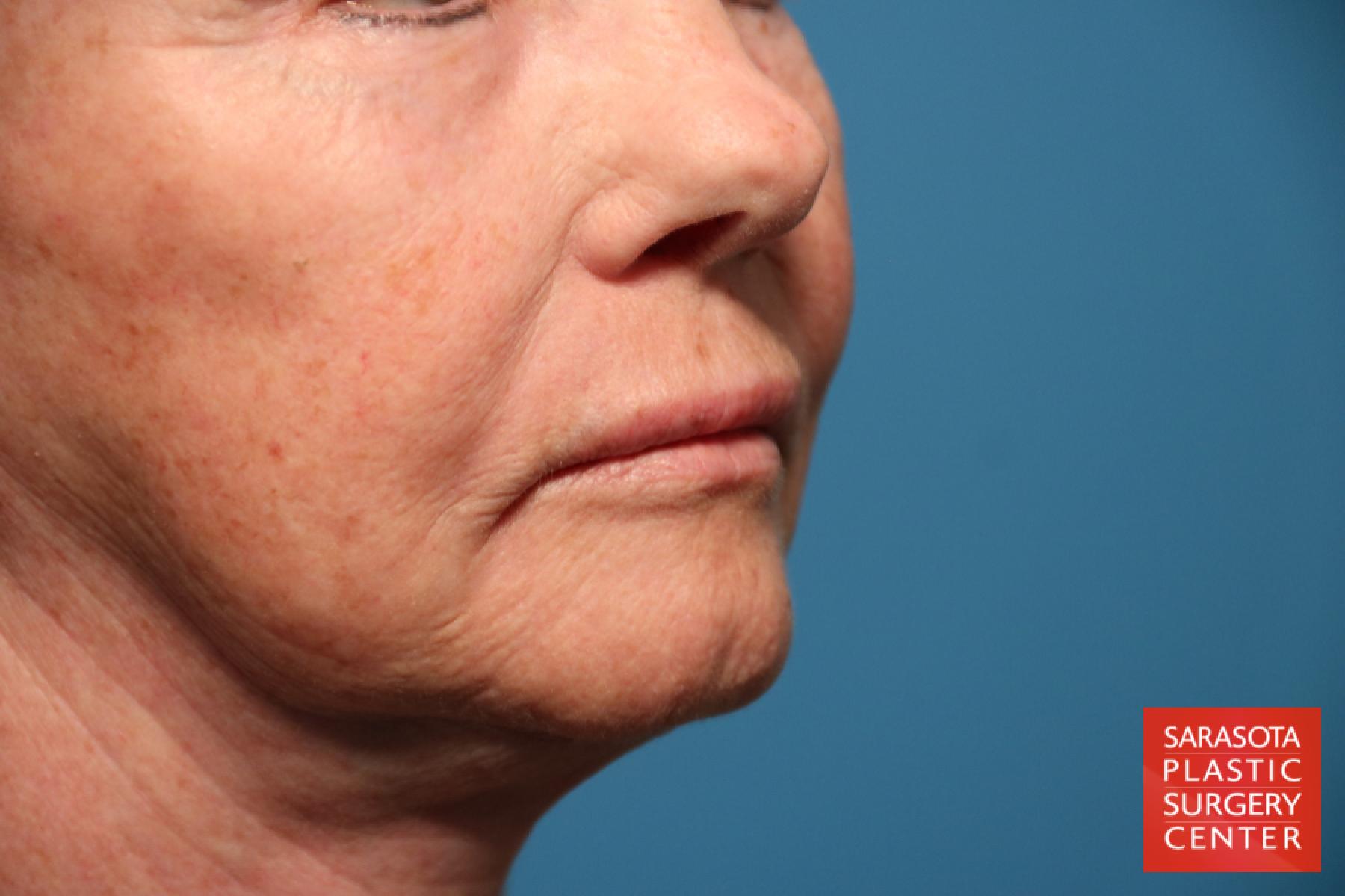 Laser Skin Resurfacing - Face: Patient 14 - After 3