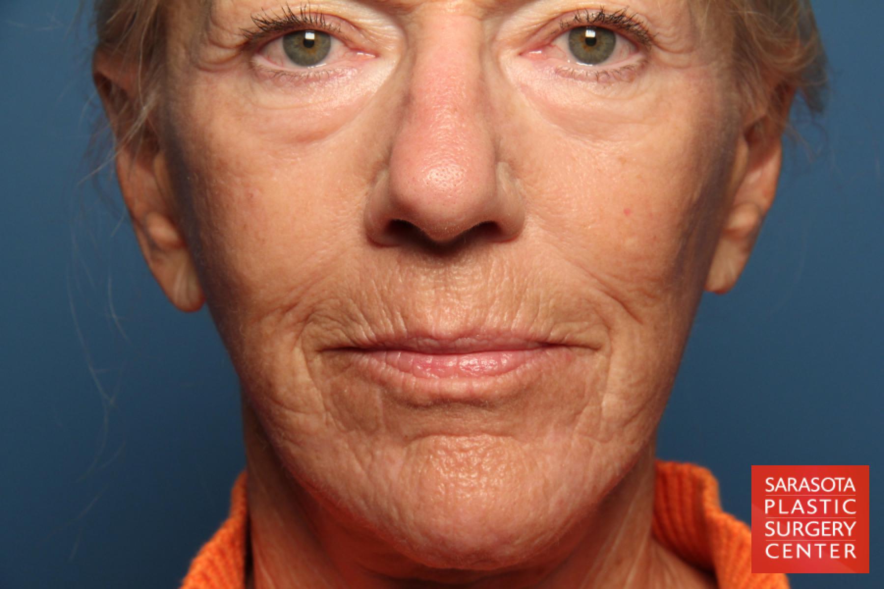 Laser Skin Resurfacing - Face: Patient 8 - After  