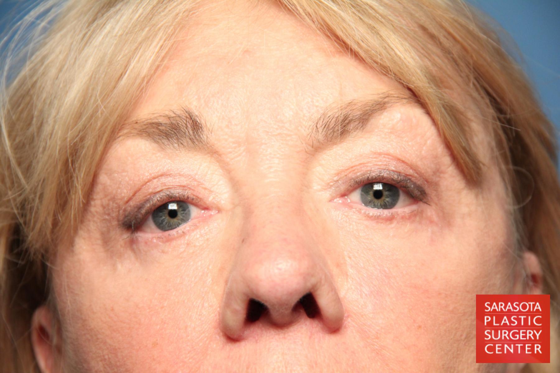 Eyelid Lift: Patient 23 - After 1